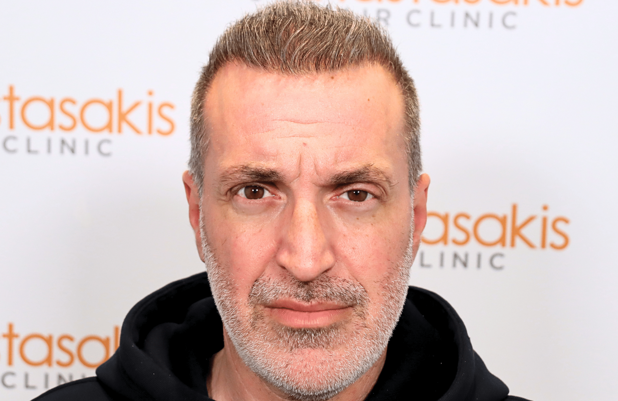 hair transplant result 2600 fus grey 1st stage