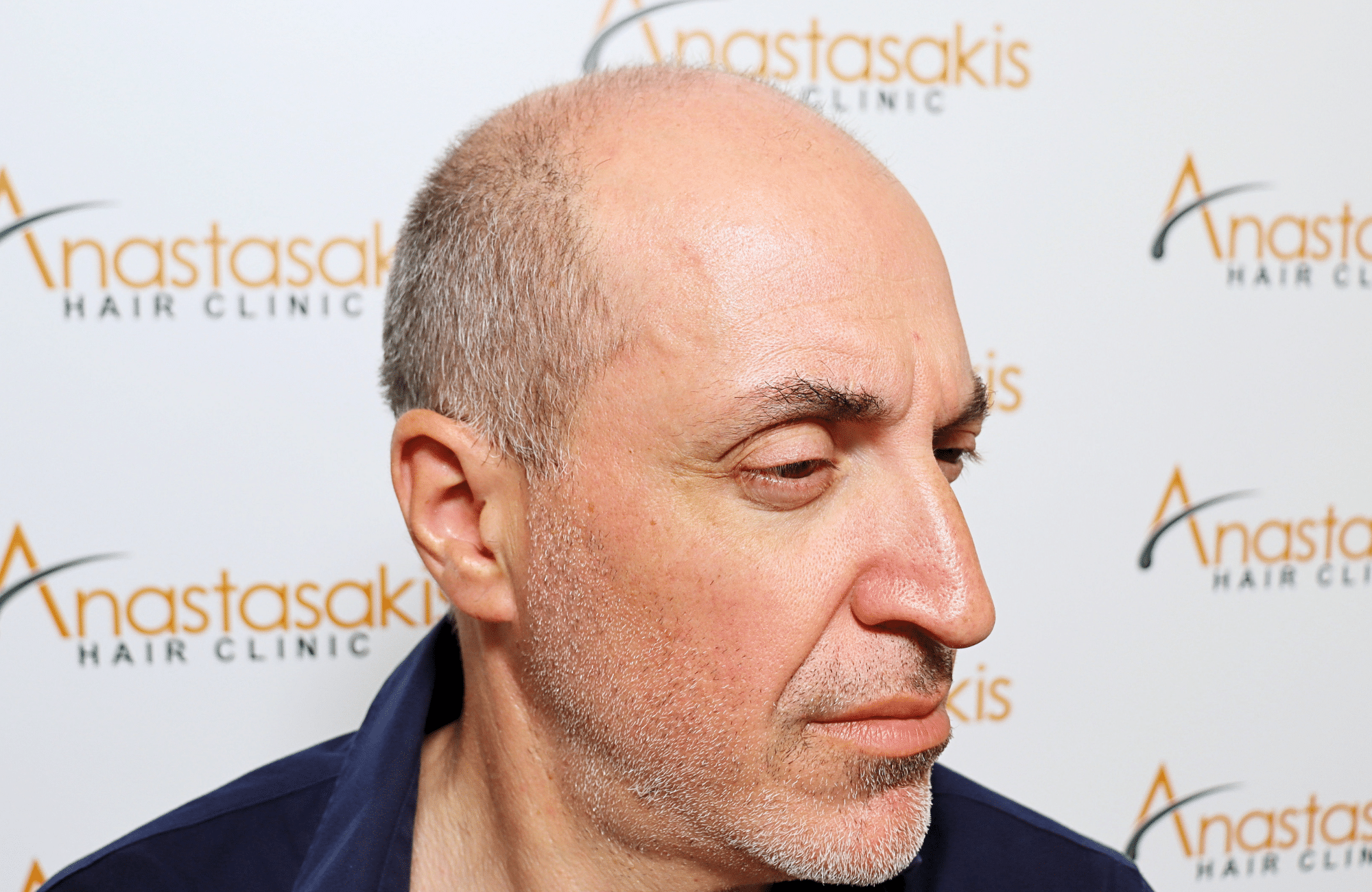 hair transplant result 2600 fus grey 1st stage