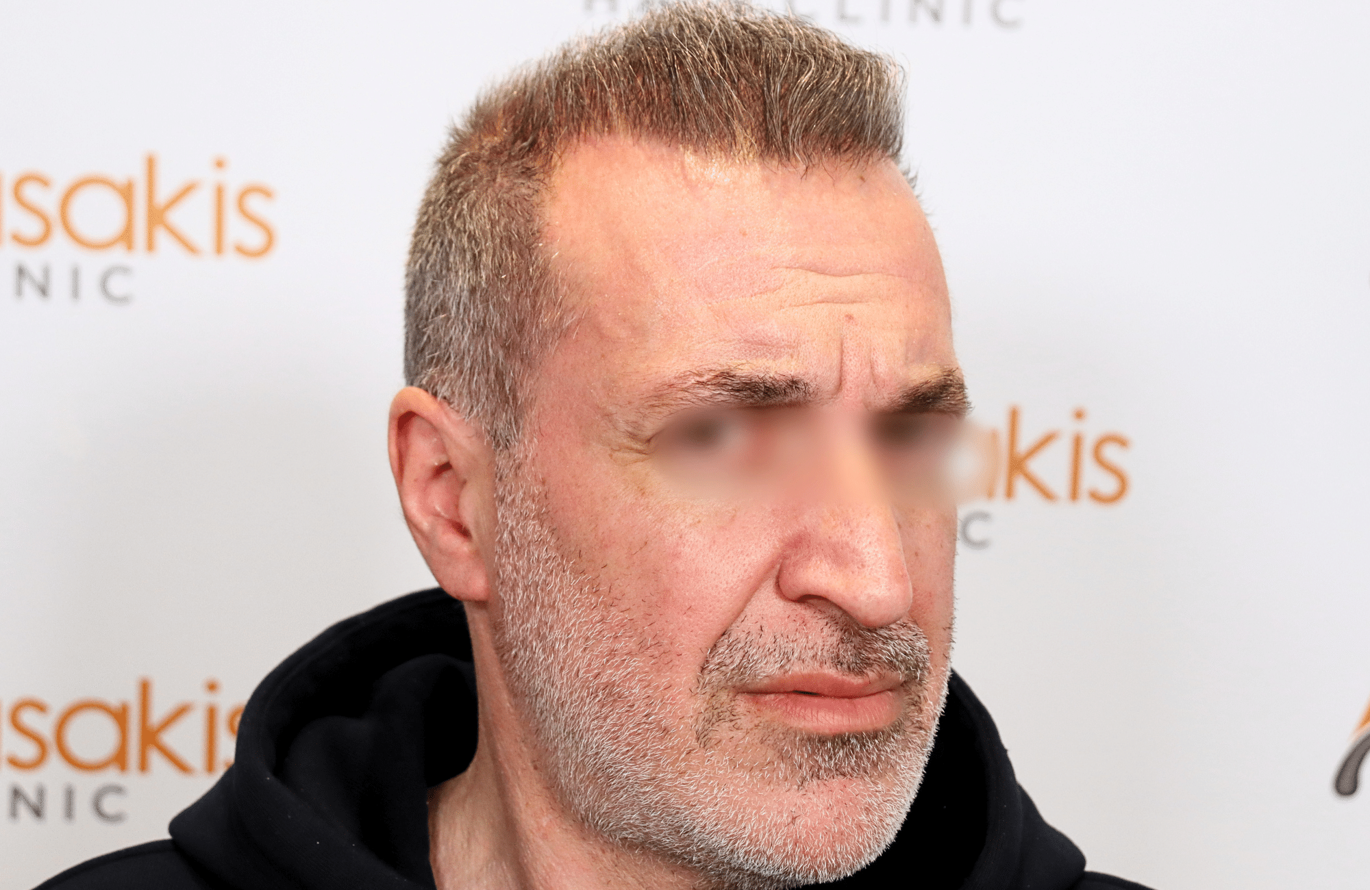 hair transplant result 2600 fus grey 1st stage