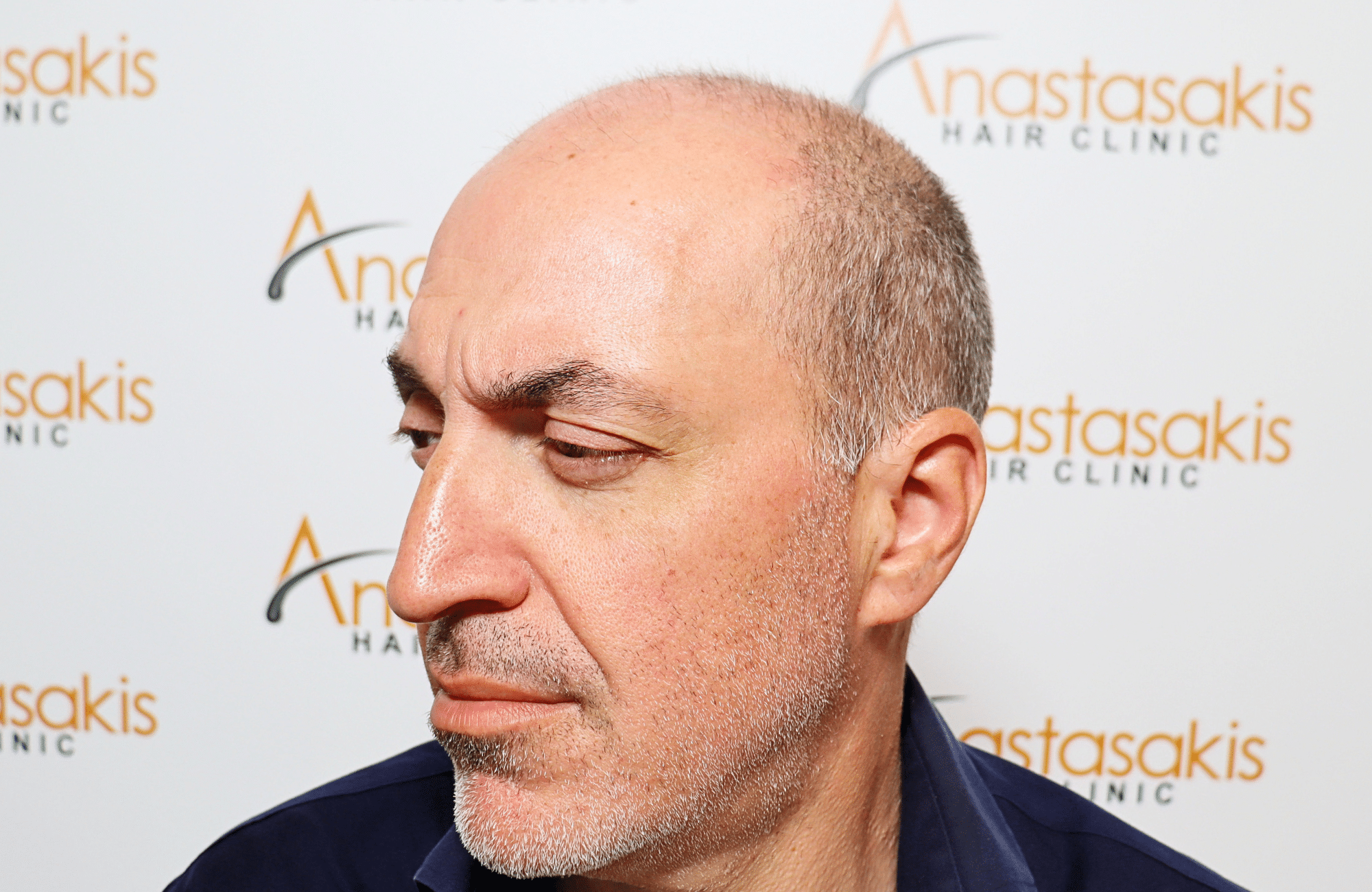 hair transplant result 2600 fus grey 1st stage