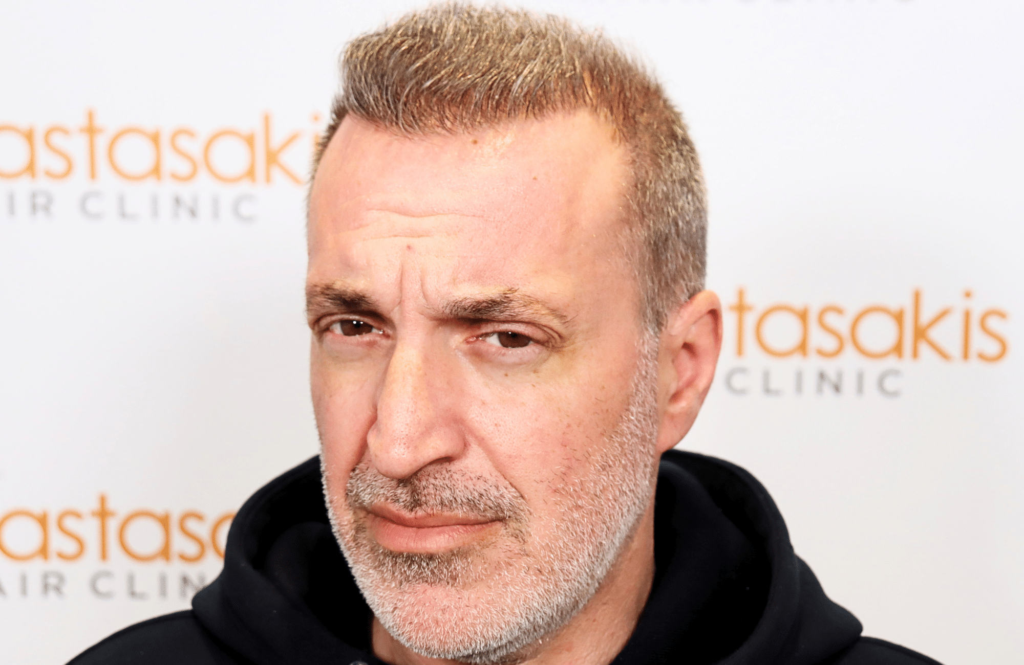 hair transplant result 2600 fus grey 1st stage
