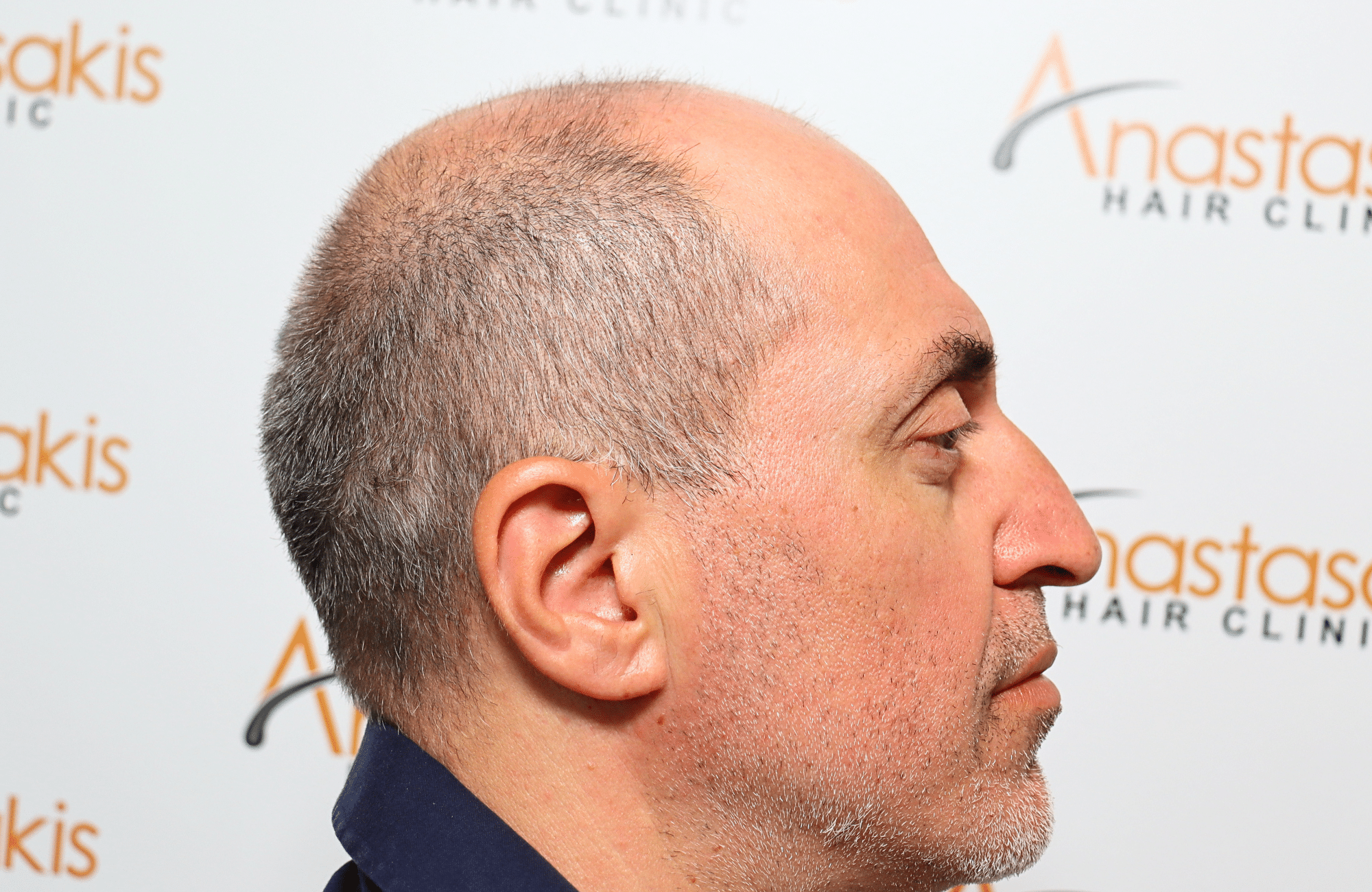 hair transplant result 2600 fus grey 1st stage