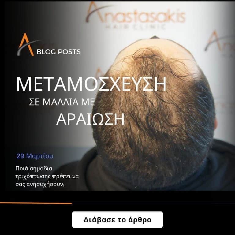 Μεταμόσχευση σε μαλλιά με αραίωση: Ποια από τα πρώτα σημάδια τριχόπτωσης πρέπει να σας ανησυχήσουν; 
