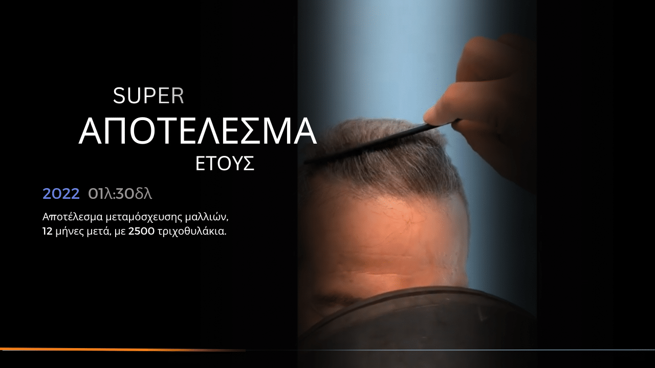 1 χρονο μετα η μεταμοσχευση μαλλιων σε γκριζομαλλη