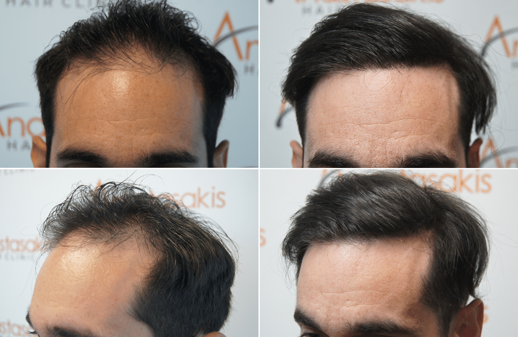 https://www.anastasakishairclinic.gr/portfolio/apotelesma-metamosxefsis-mallion-anastasakis-hair-clinic-356/