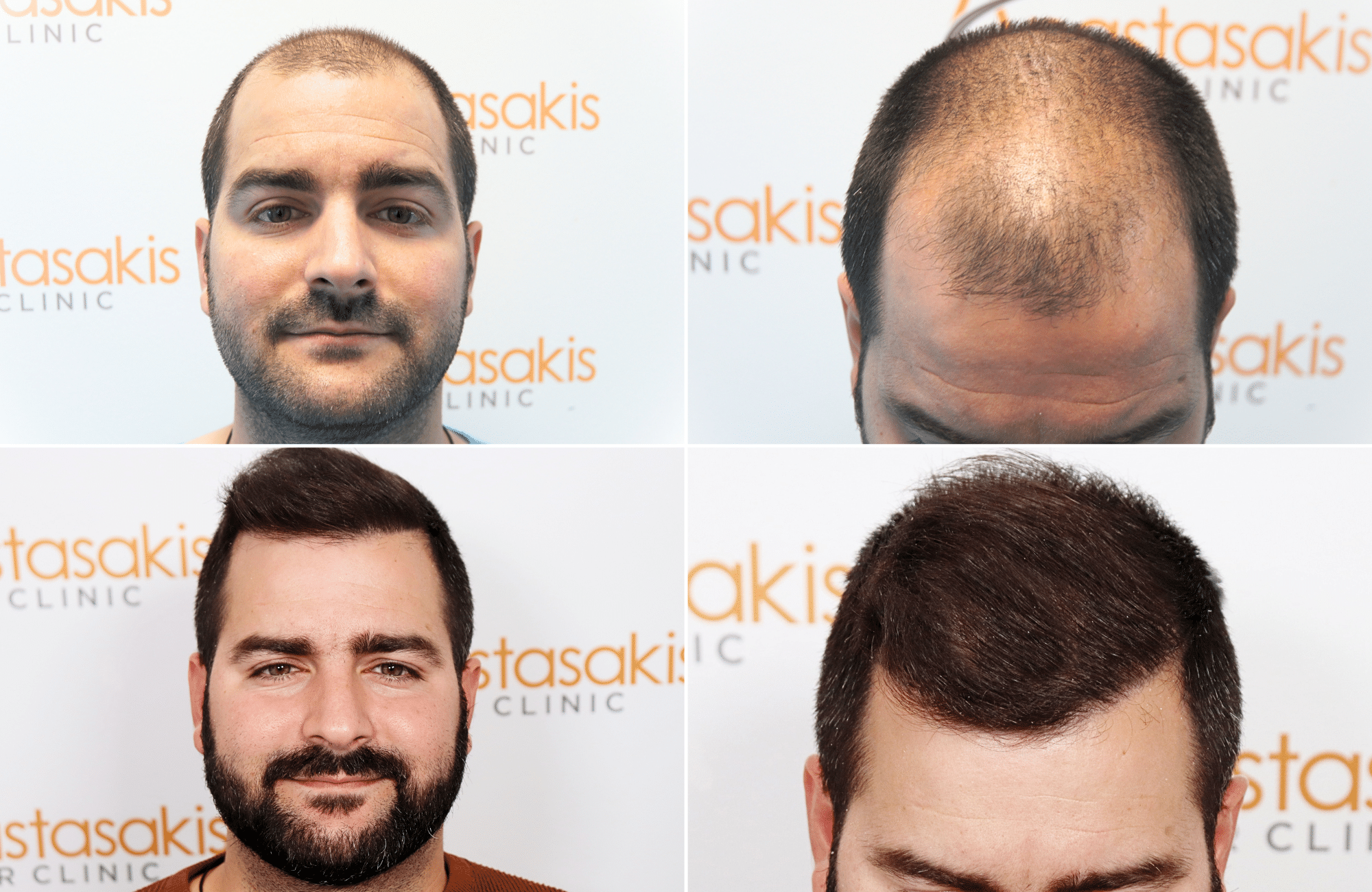 Hair transplant result 2500 fus stage5 diffusse