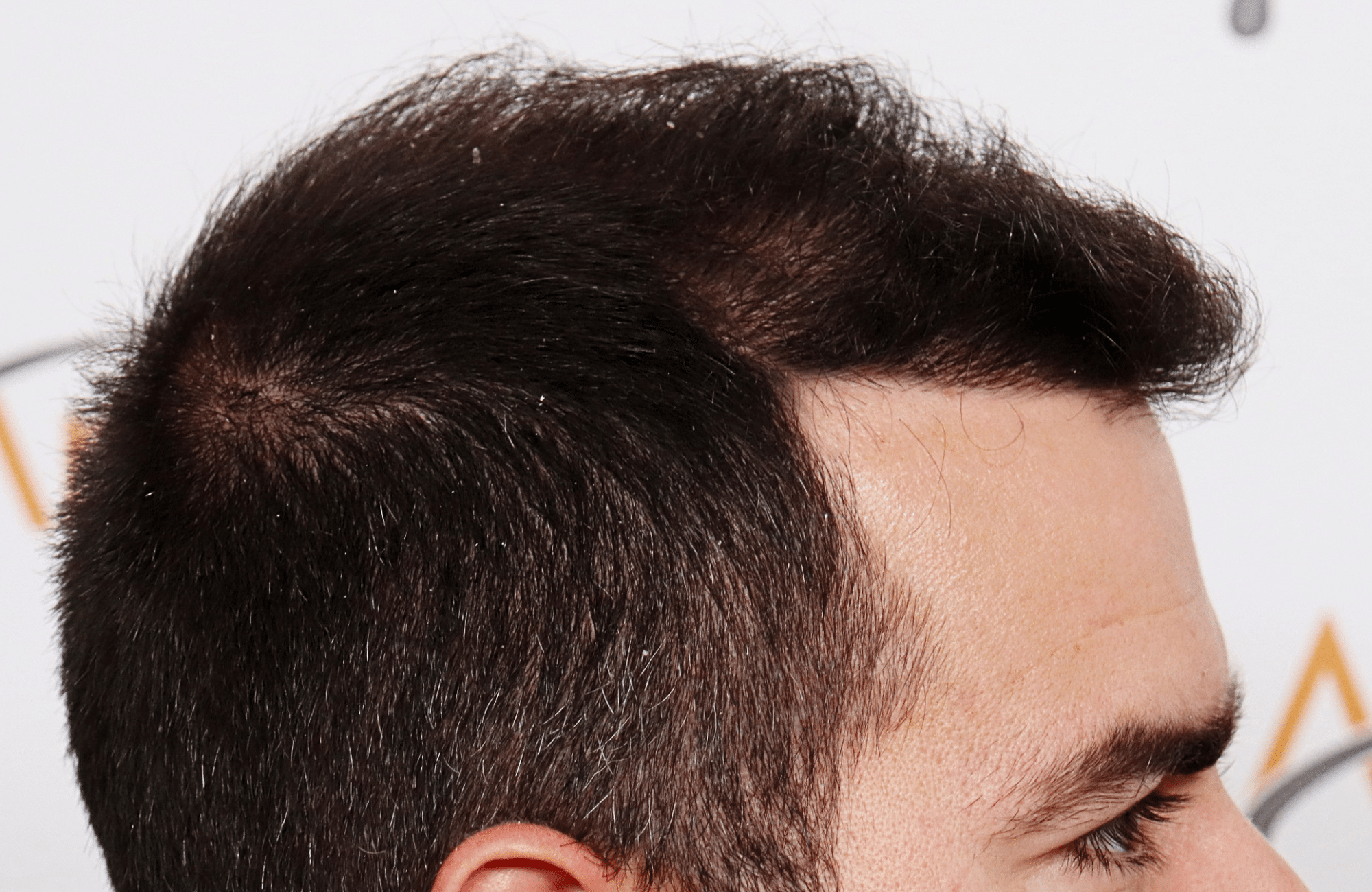 Hair transplant result 2500 fus stage5 diffusse