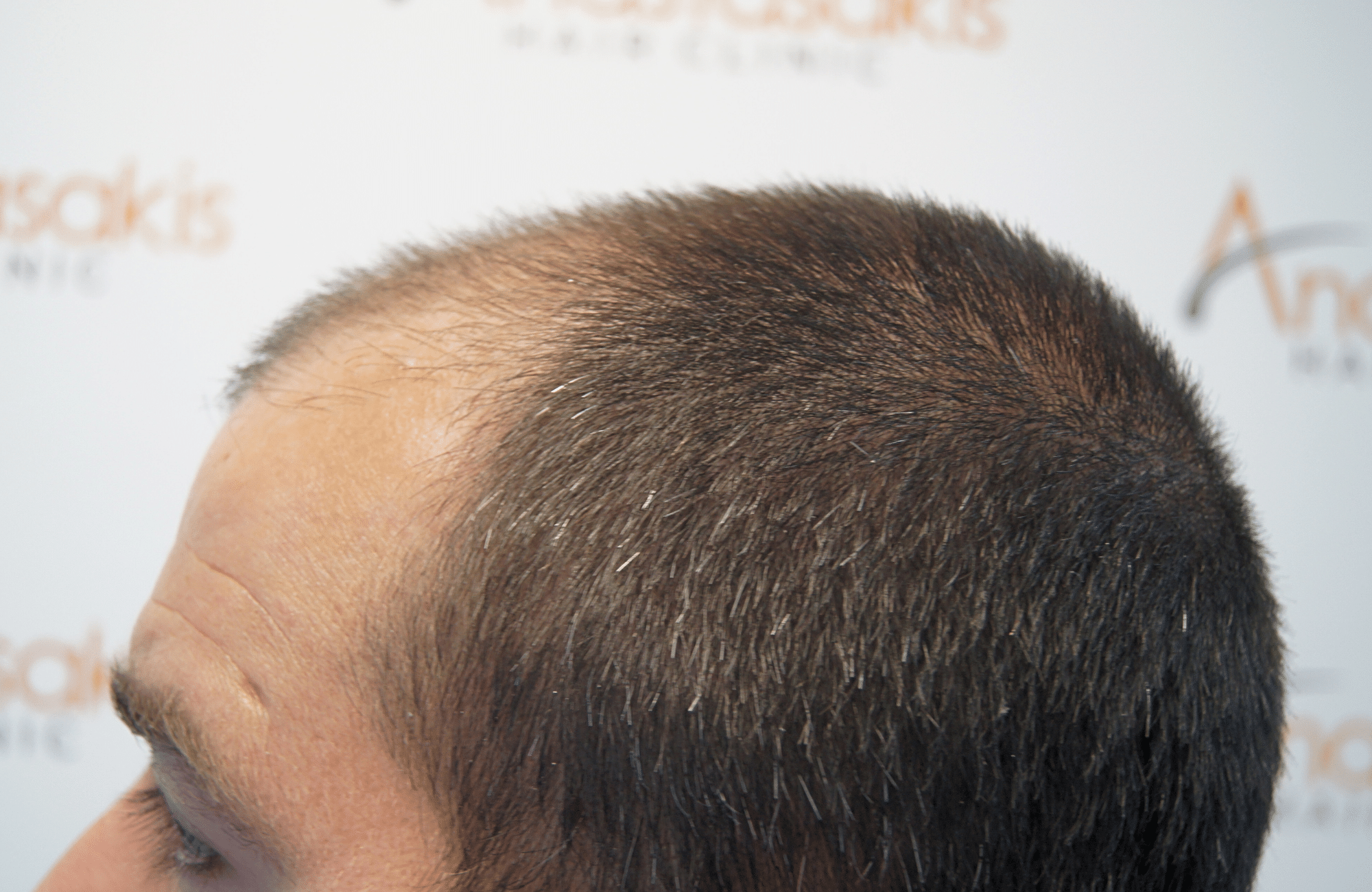 Hair transplant result 2500 fus stage5 diffusse