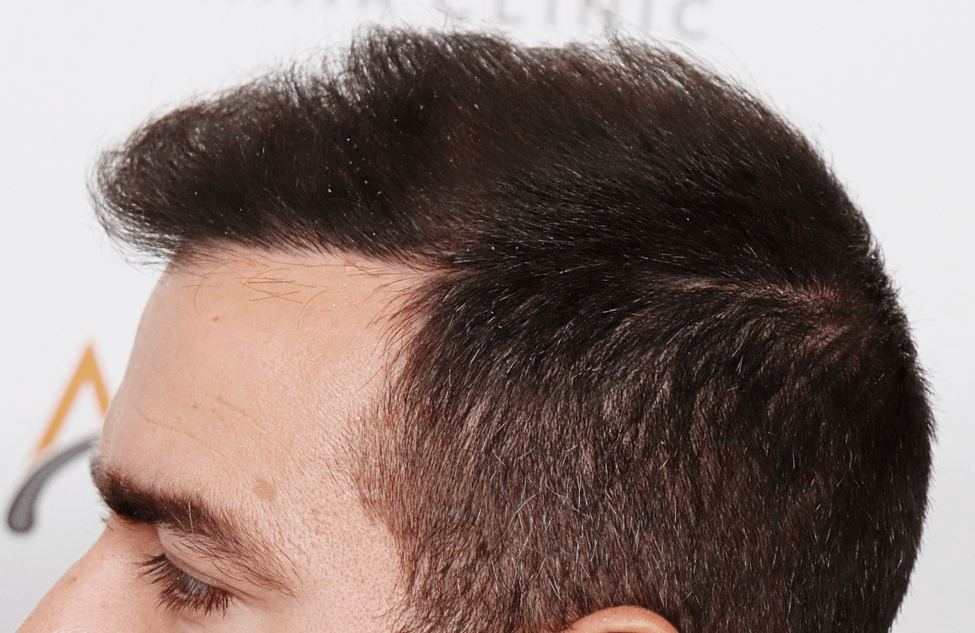 Hair transplant result 2500 fus stage5 diffusse