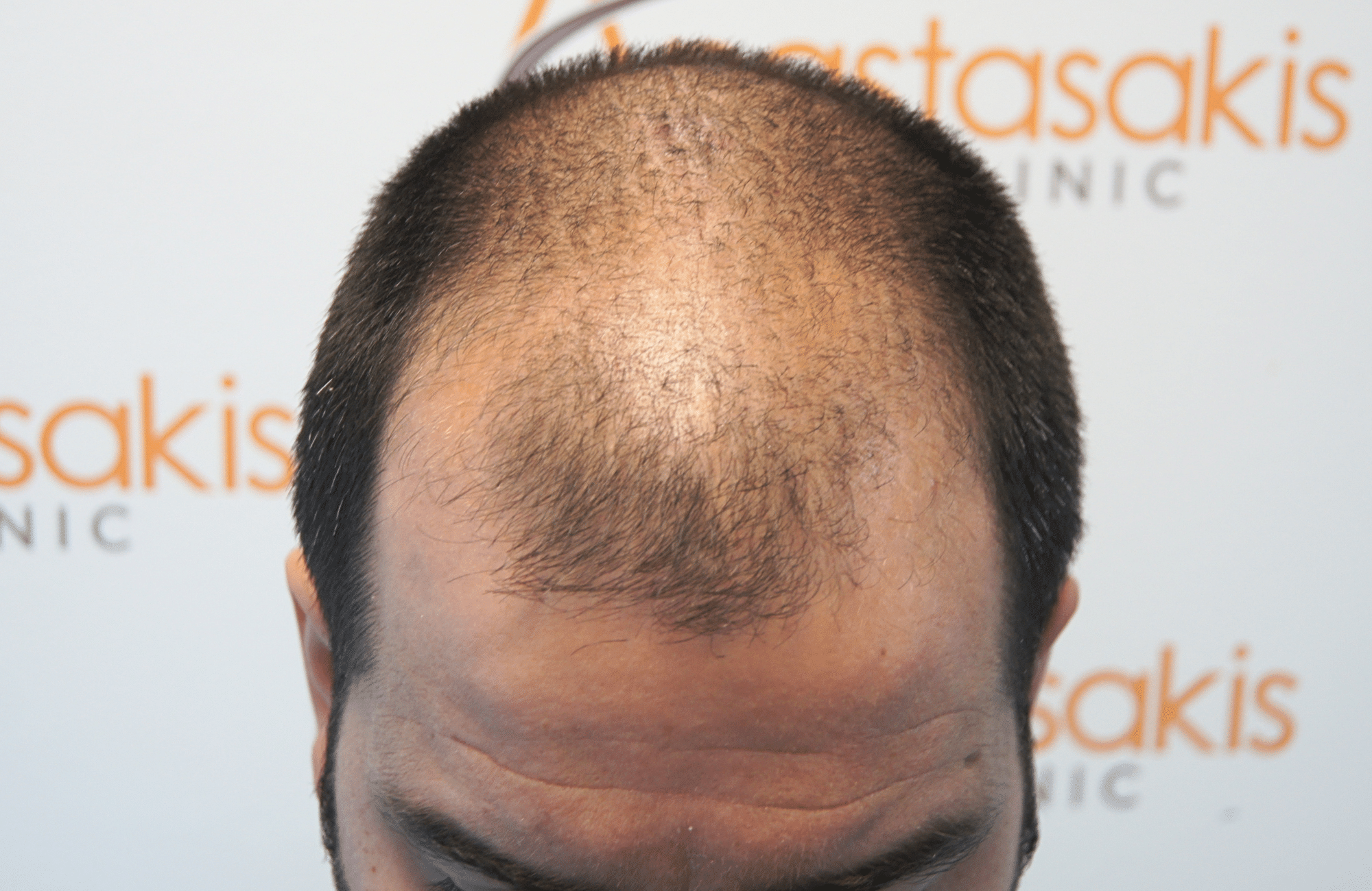 Hair transplant result 2500 fus stage5 diffusse