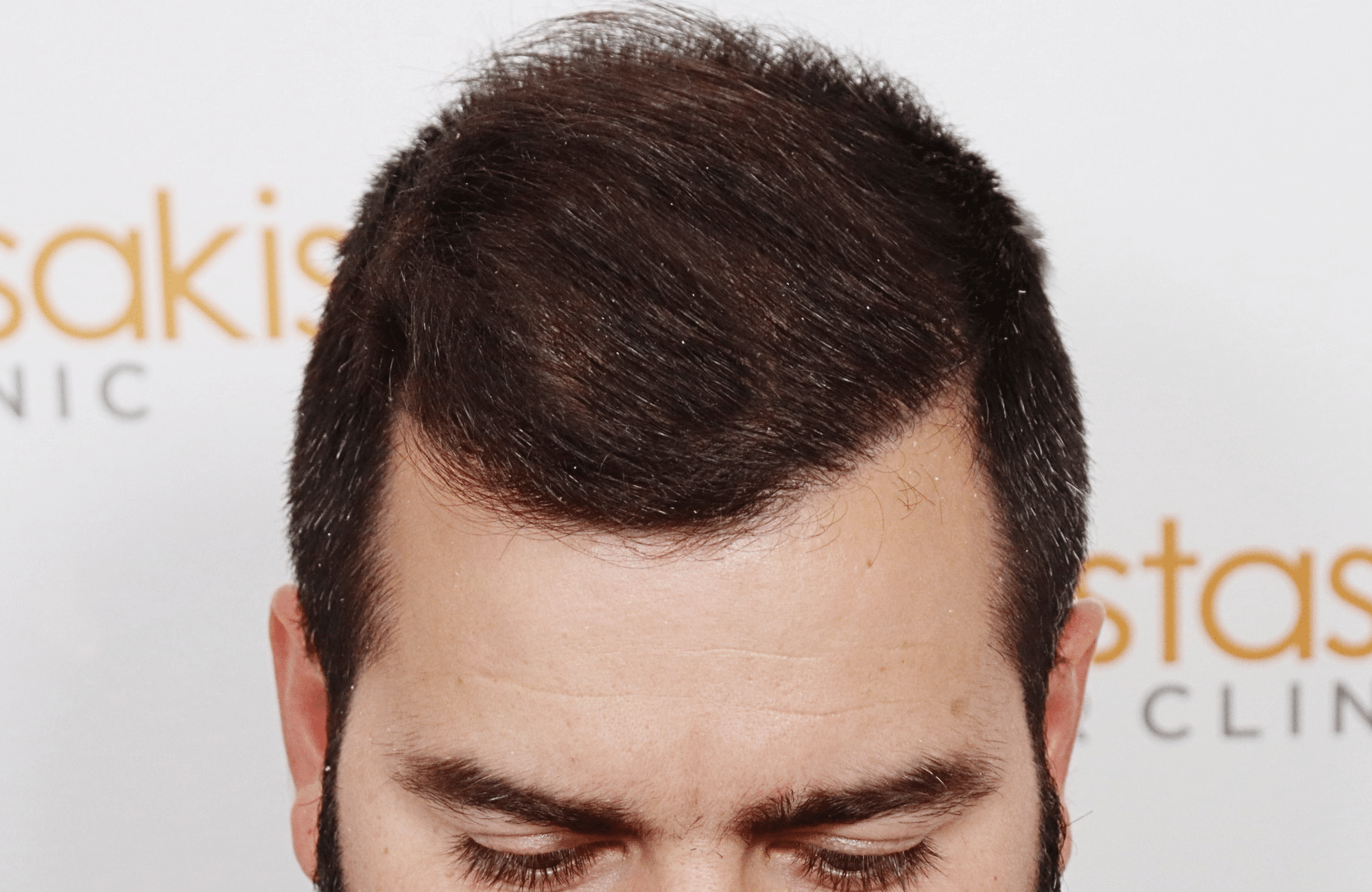Hair transplant result 2500 fus stage5 diffusse