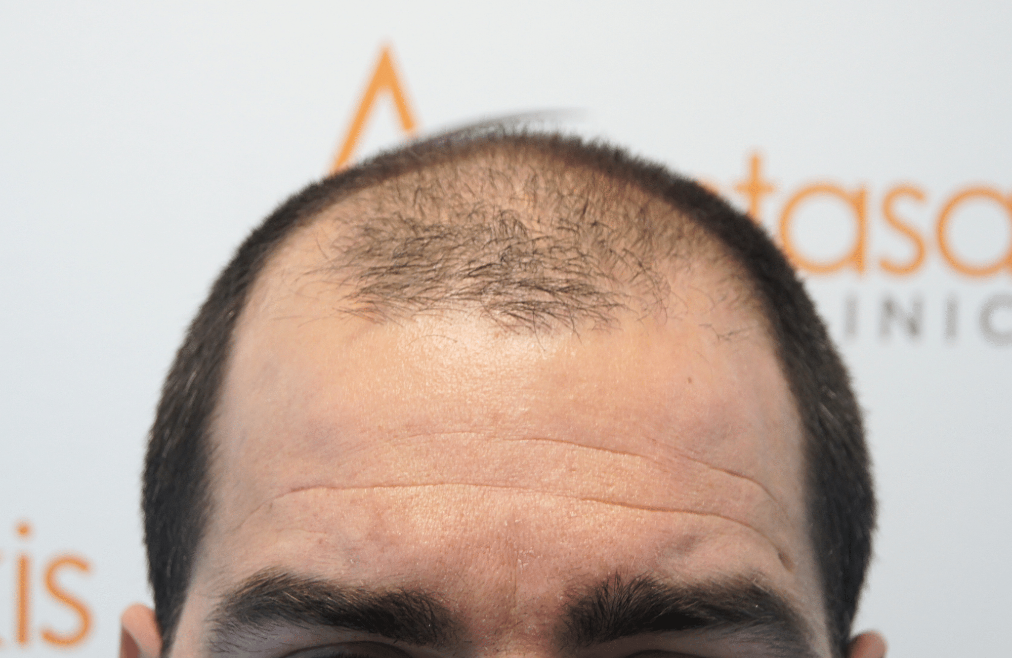 Hair transplant result 2500 fus stage5 diffusse