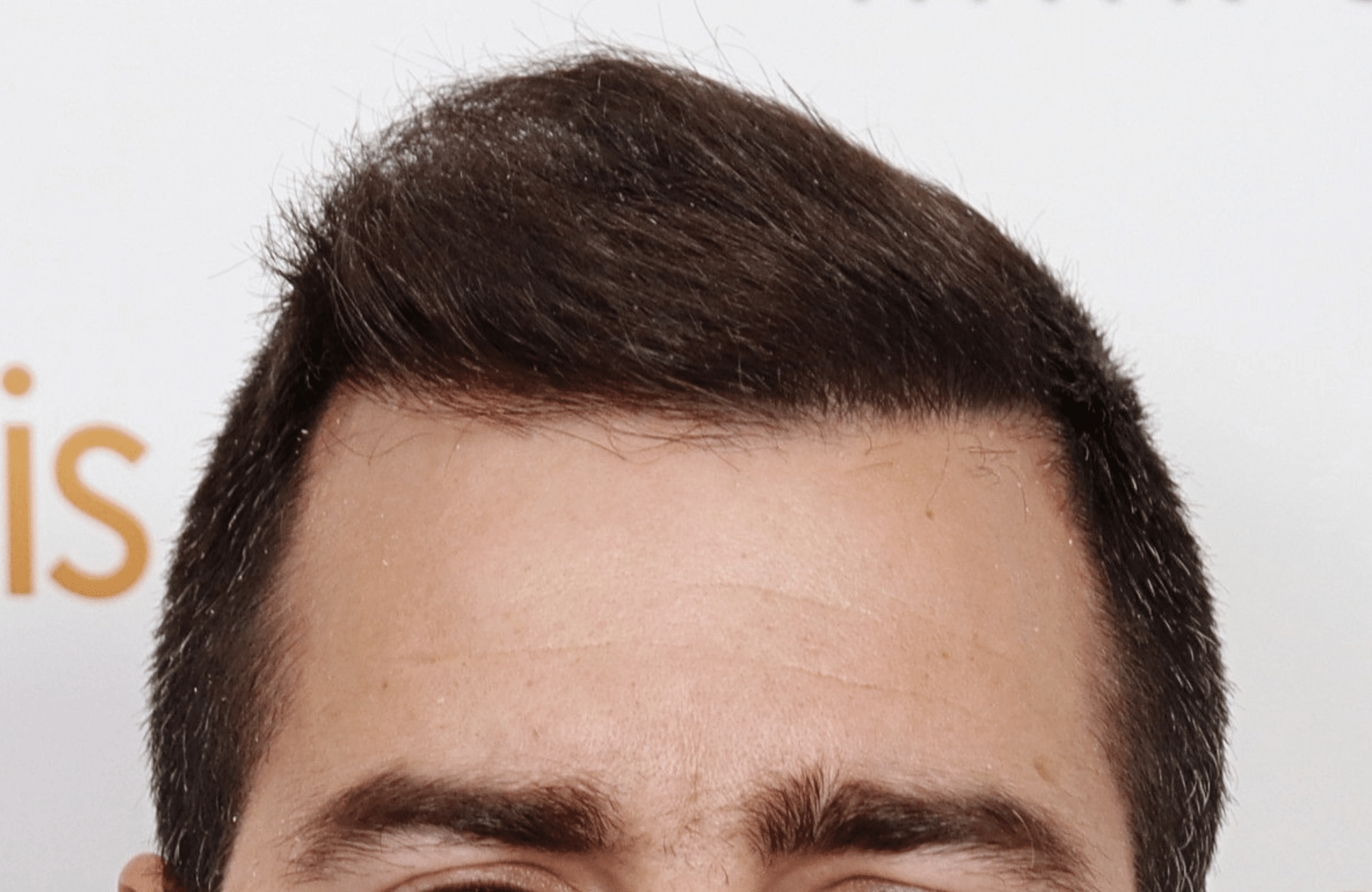 Hair transplant result 2500 fus stage5 diffusse