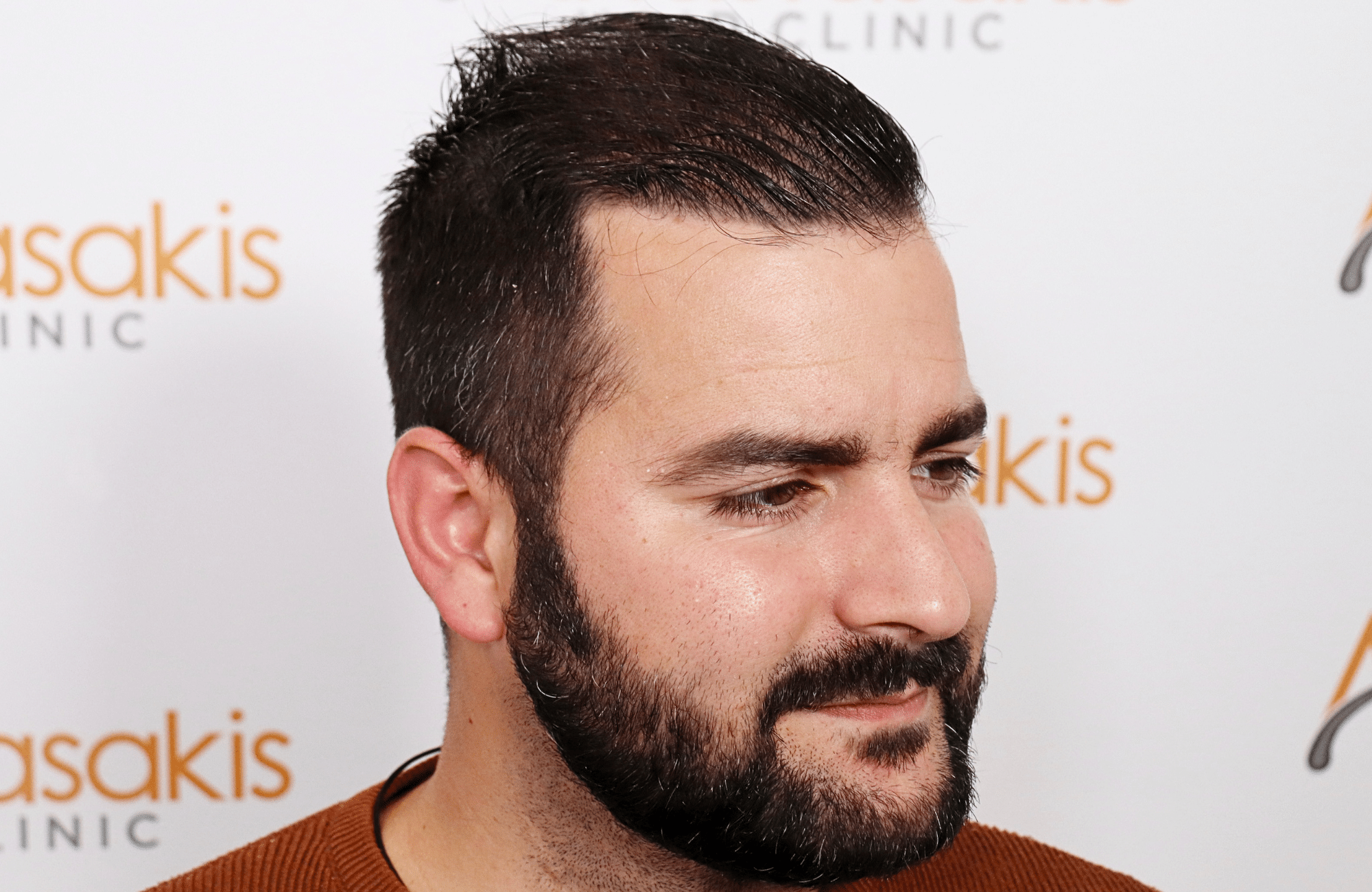 Hair transplant result 2500 fus stage5 diffusse