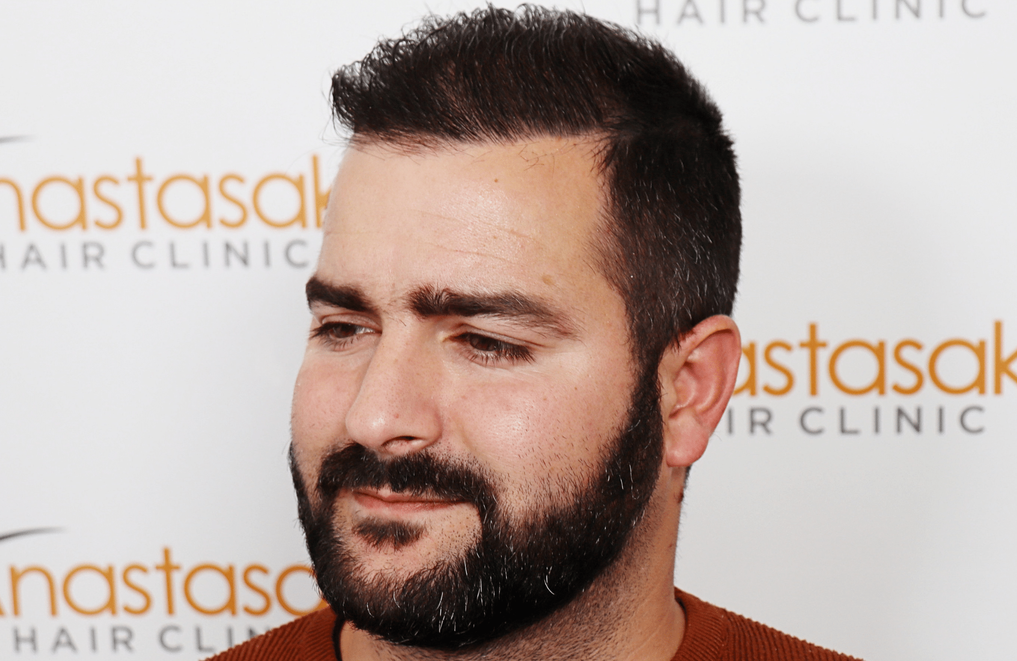 Hair transplant result 2500 fus stage5 diffusse