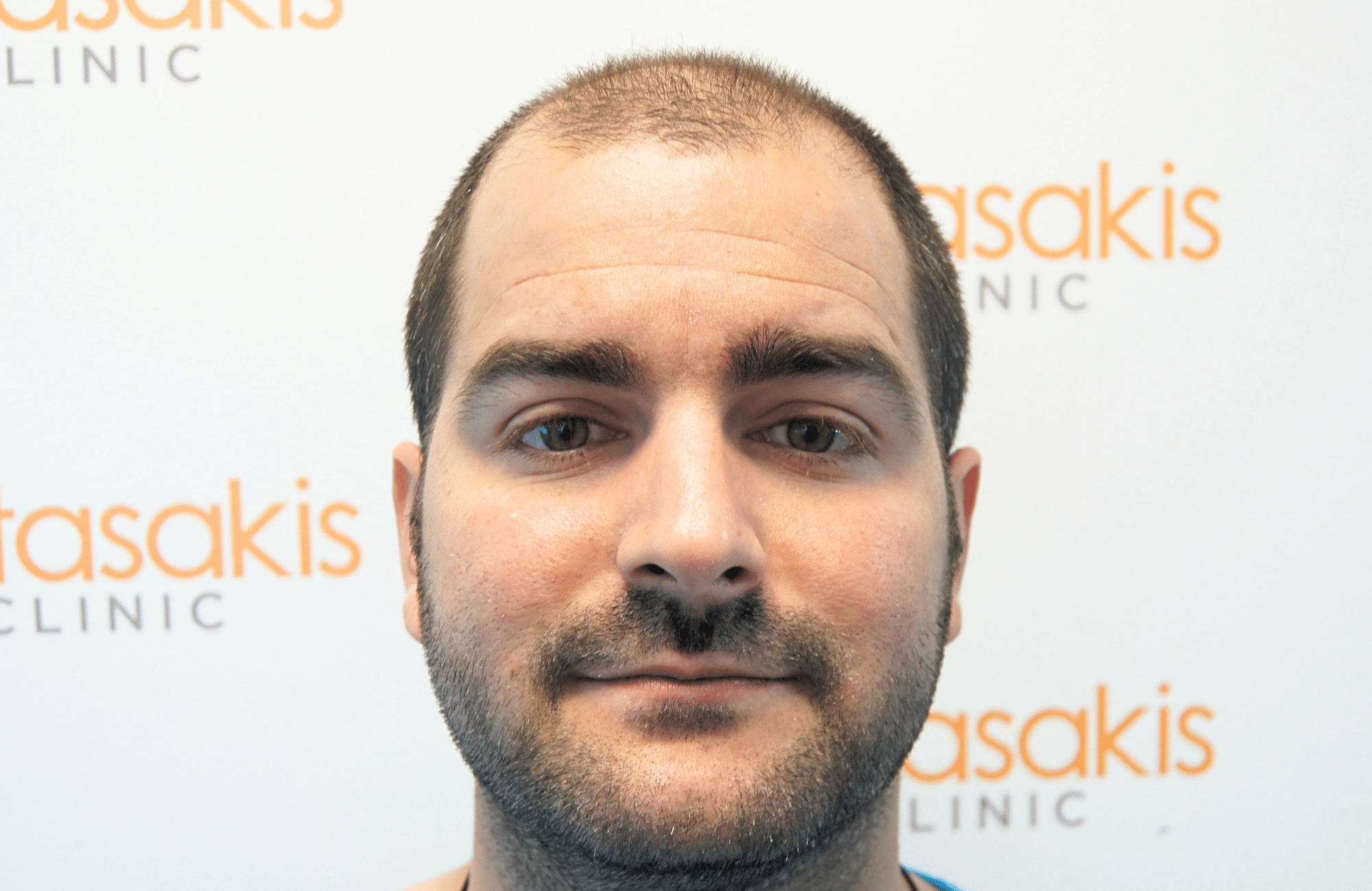 Hair transplant result 2500 fus stage5 diffusse