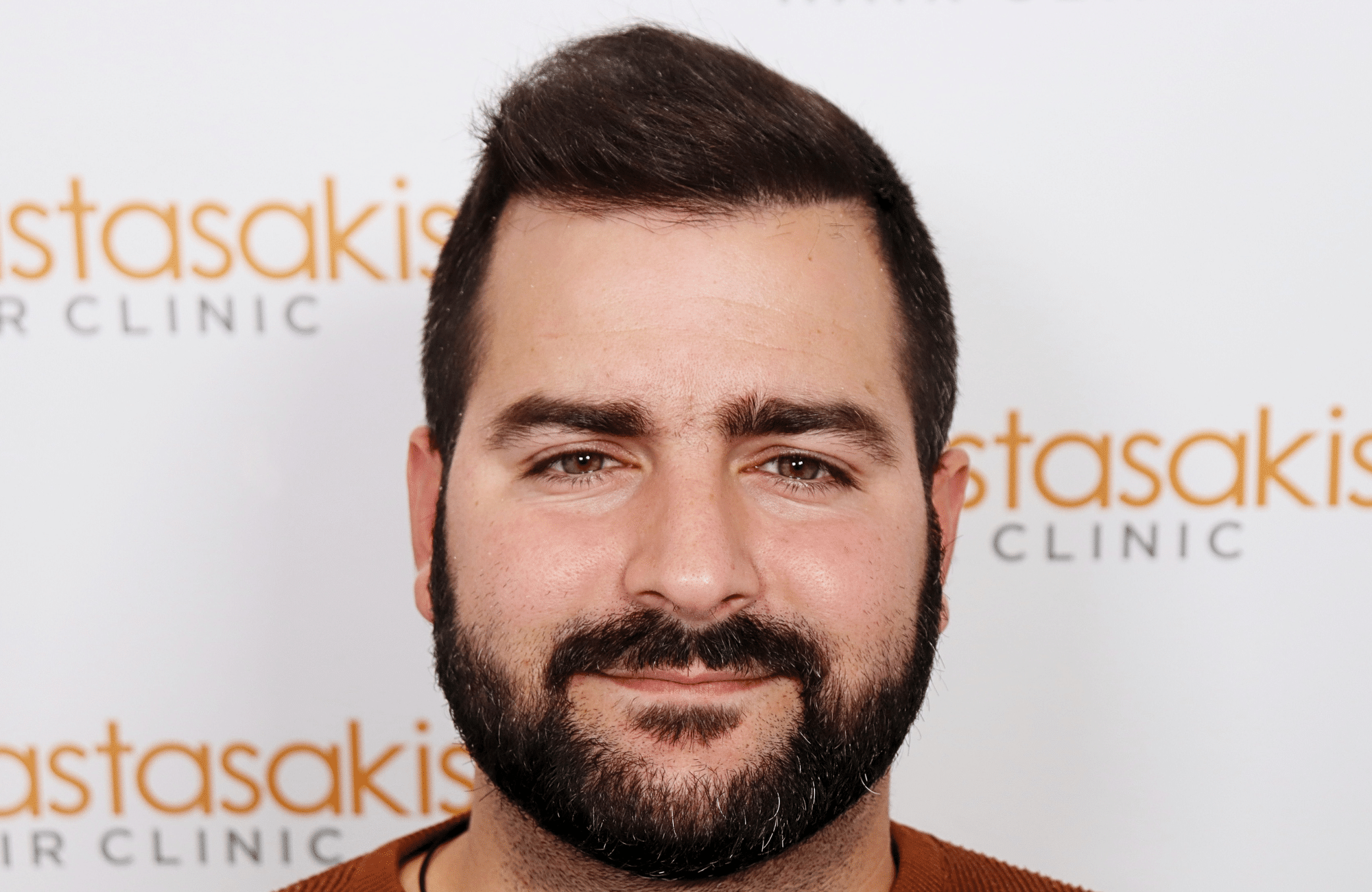 Hair transplant result 2500 fus stage5 diffusse