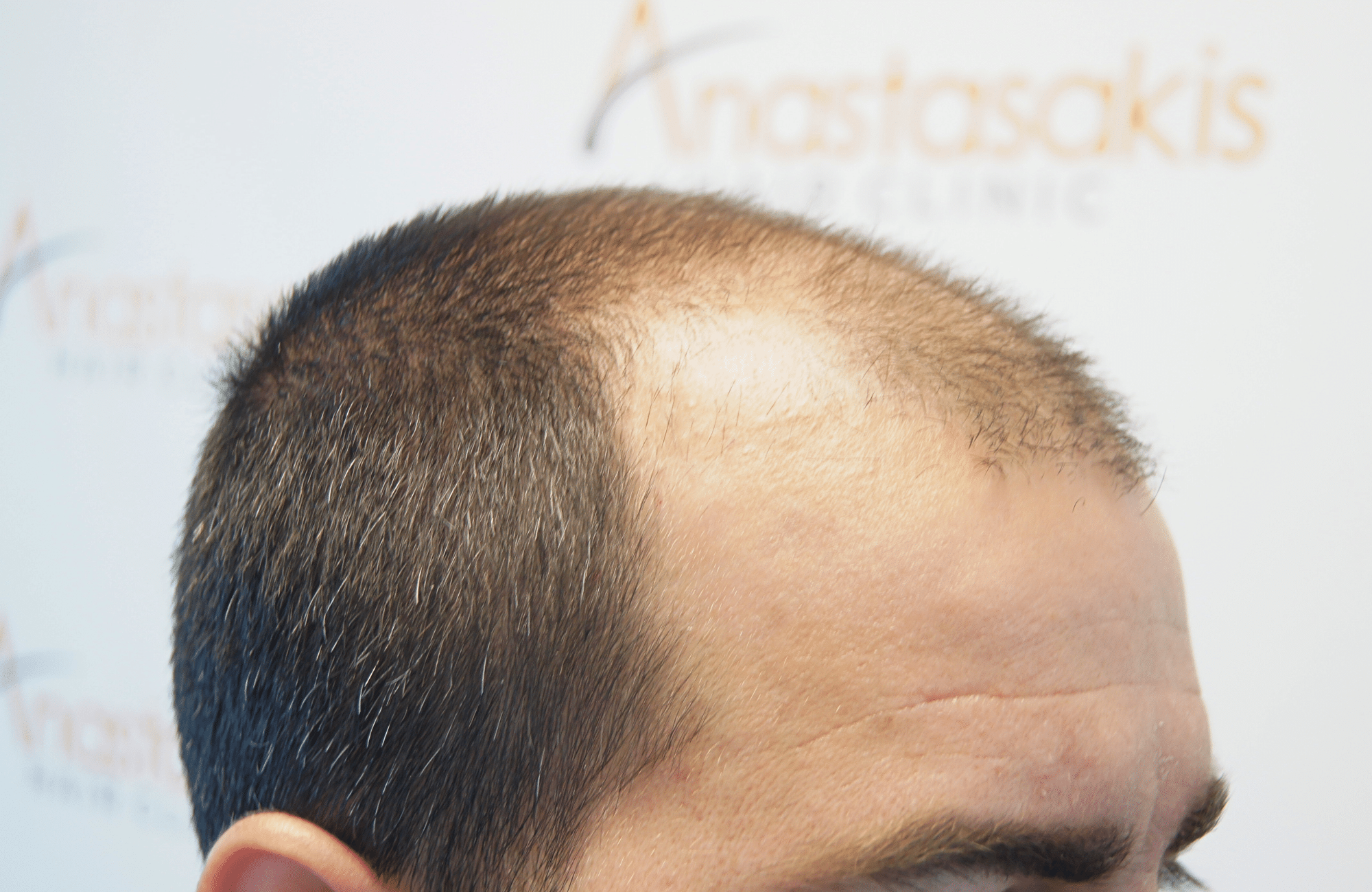 Hair transplant result 2500 fus stage5 diffusse