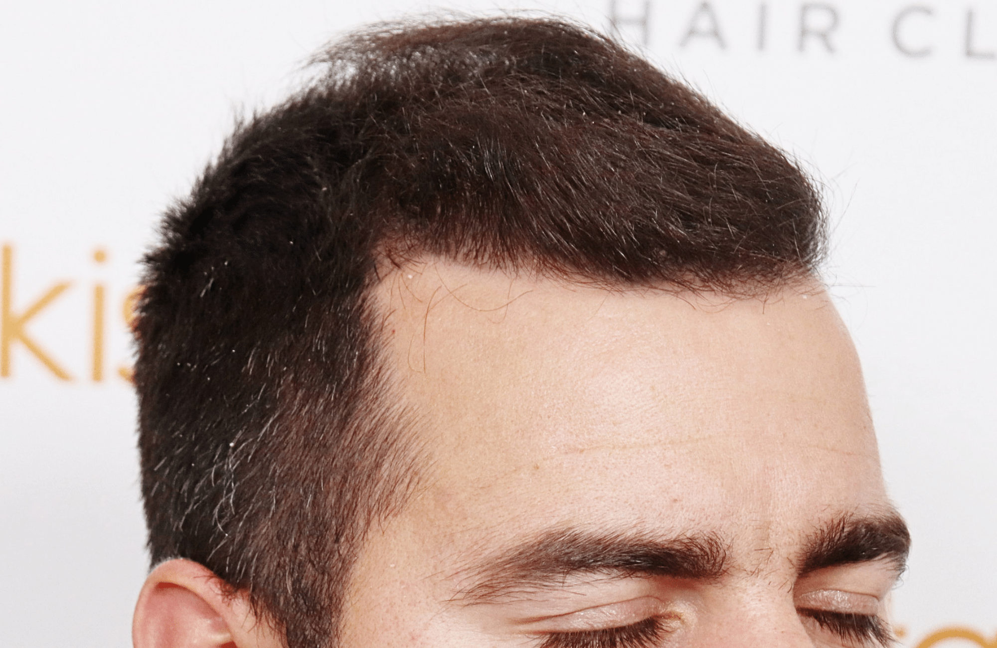 Hair transplant result 2500 fus stage5 diffusse