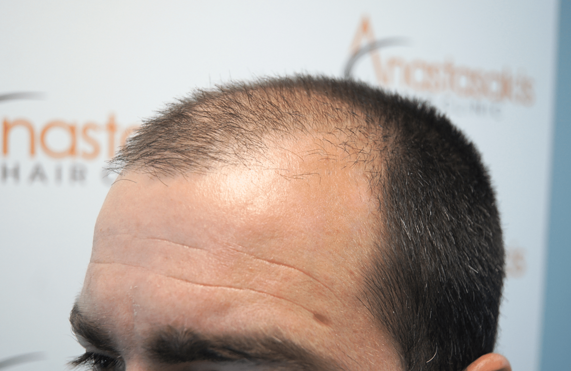 Hair transplant result 2500 fus stage5 diffusse