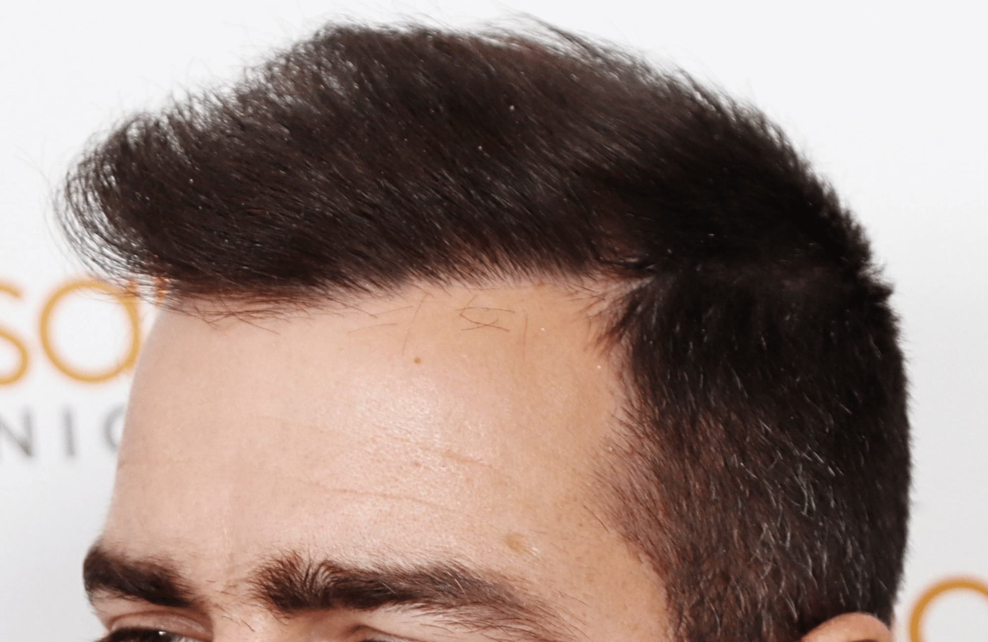 Hair transplant result 2500 fus stage5 diffusse