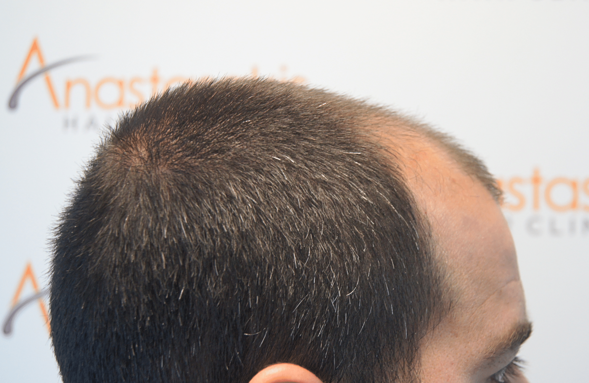 Hair transplant result 2500 fus stage5 diffusse