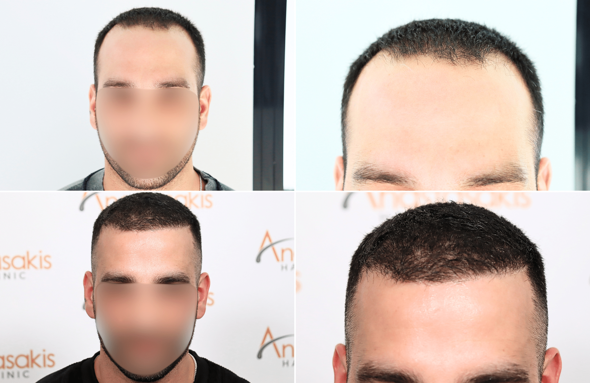 https://www.anastasakishairclinic.gr/portfolio/apotelesma-metamosxefsis-mallion-anastasakis-hair-clinic-7/