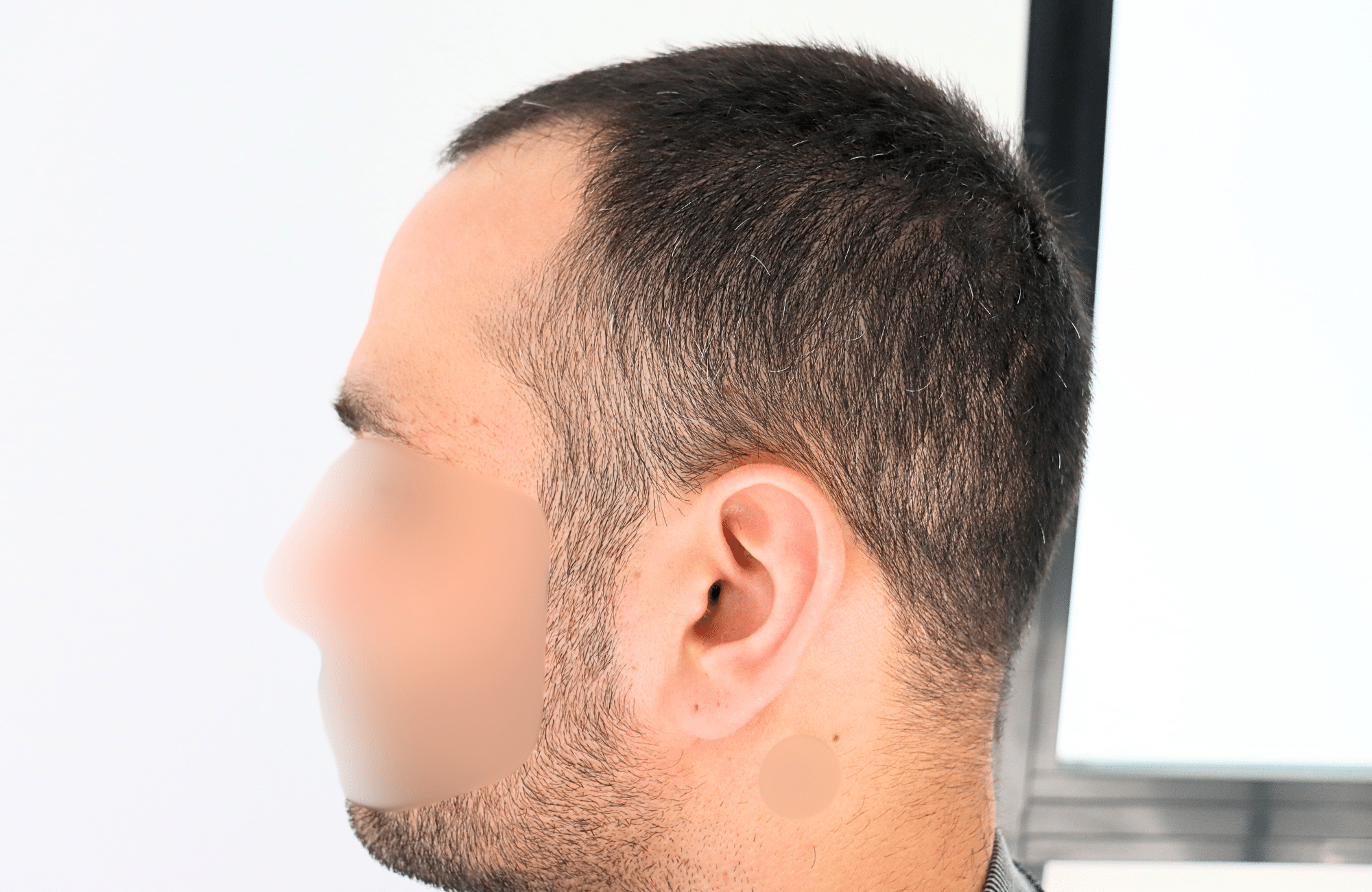 hair transplant result 2400 fus stage 3 short hair