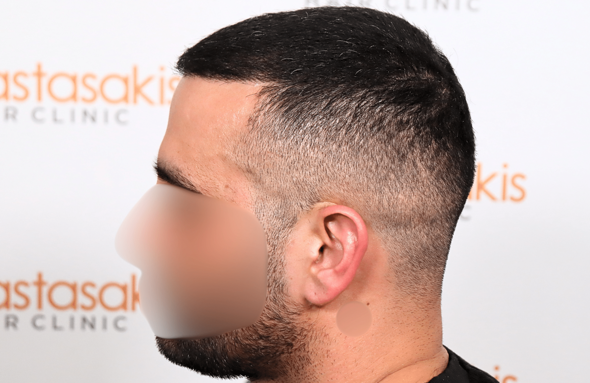 hair transplant result 2400 fus stage 3 short hair