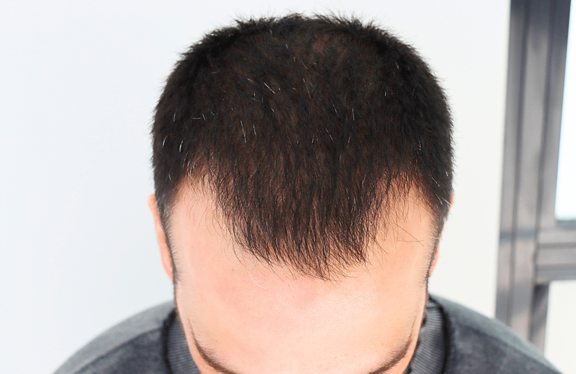 hair transplant result 2400 fus stage 3 short hair