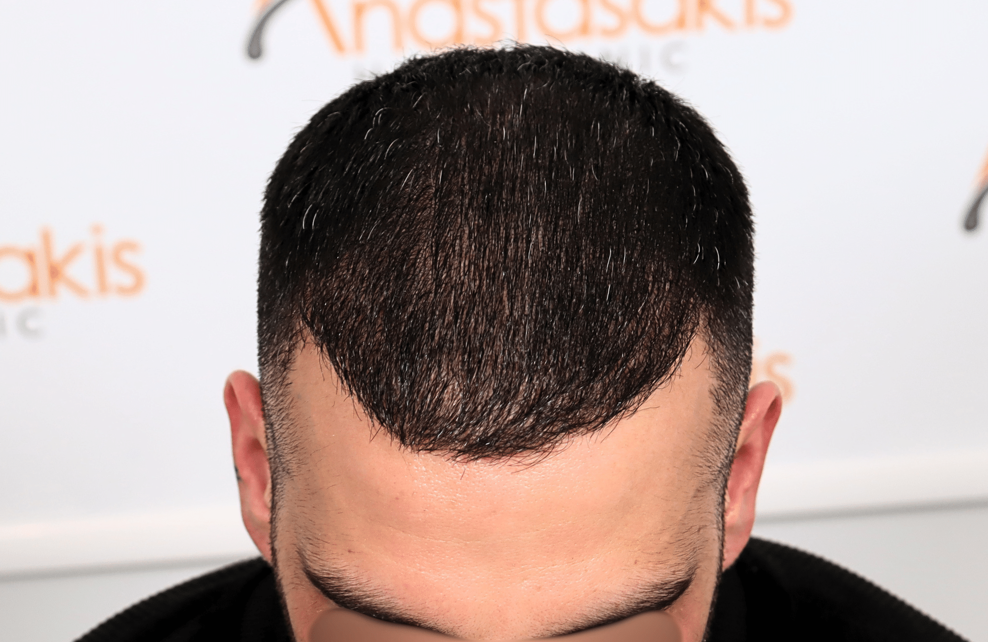 hair transplant result 2400 fus stage 3 short hair