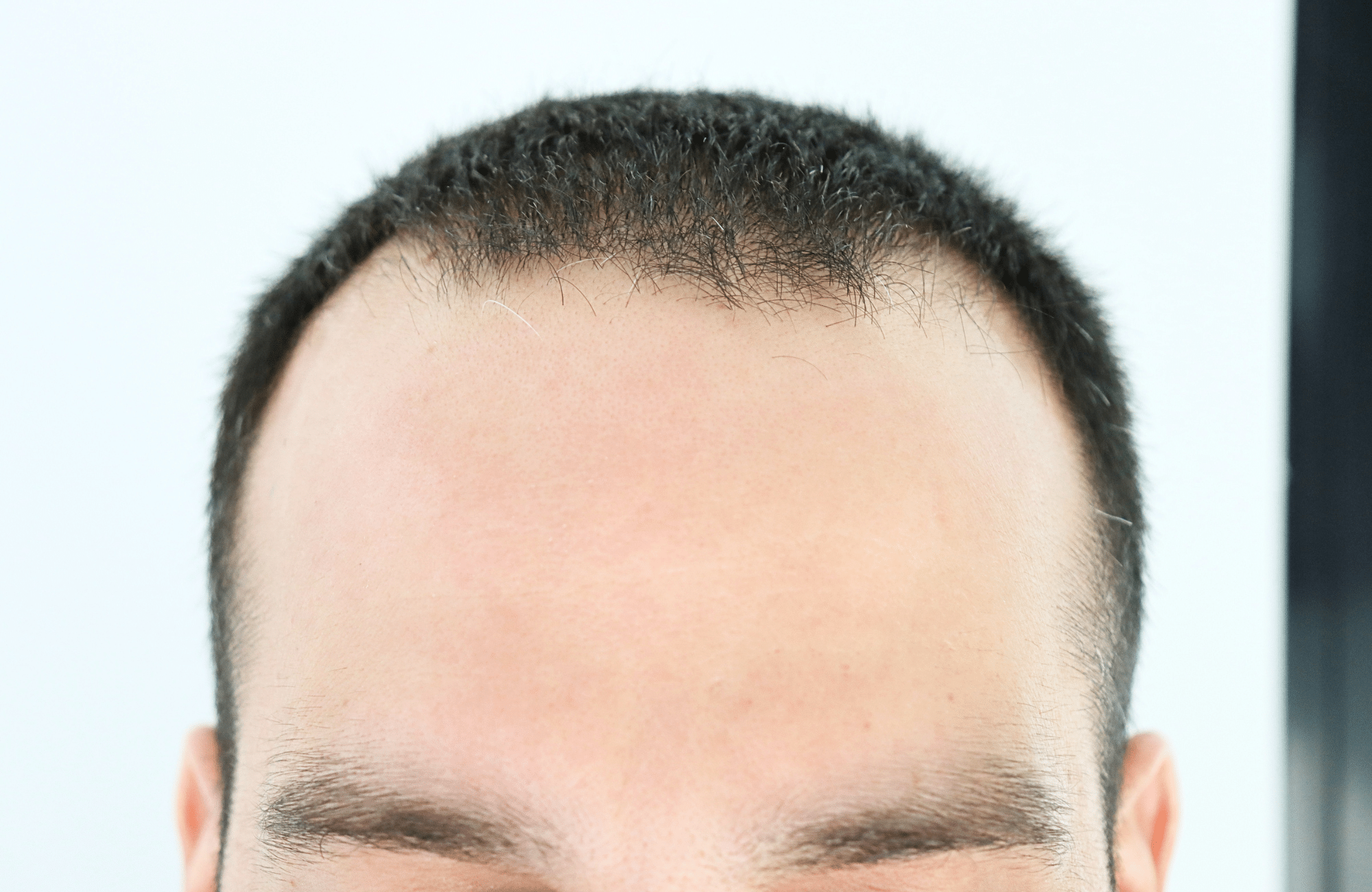 hair transplant result 2400 fus stage 3 short hair