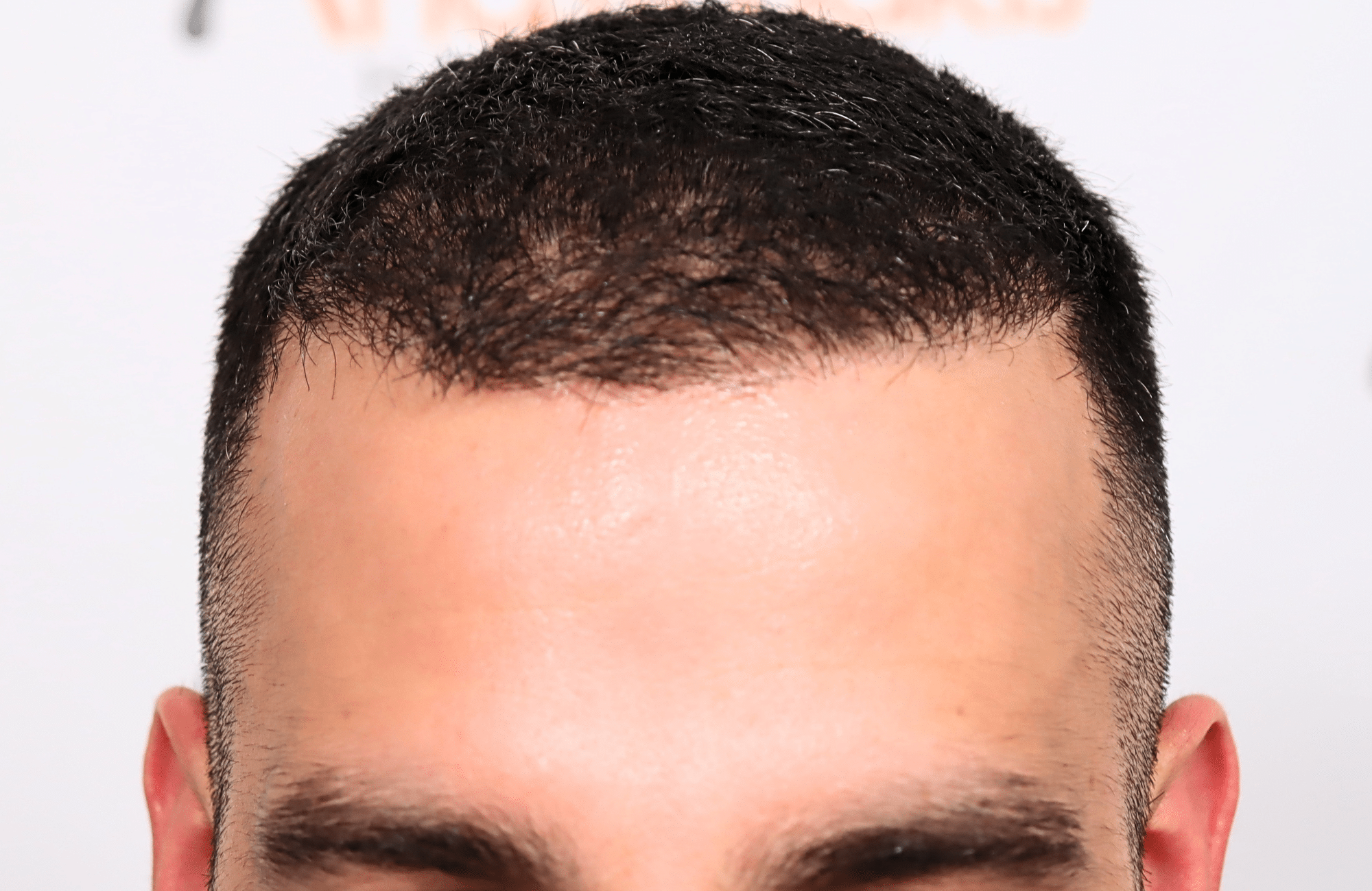 hair transplant result 2400 fus stage 3 short hair