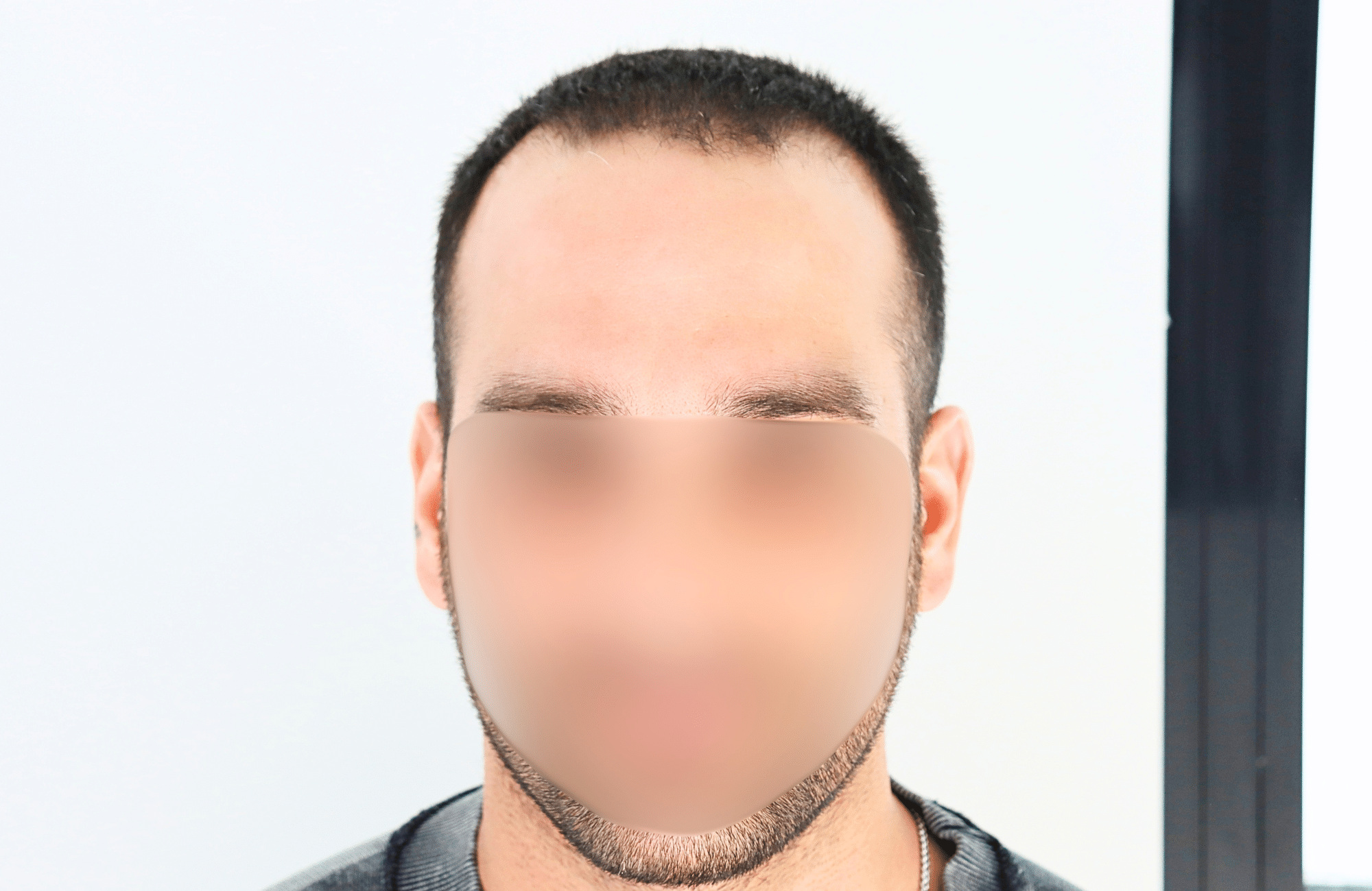 hair transplant result 2400 fus stage 3 short hair
