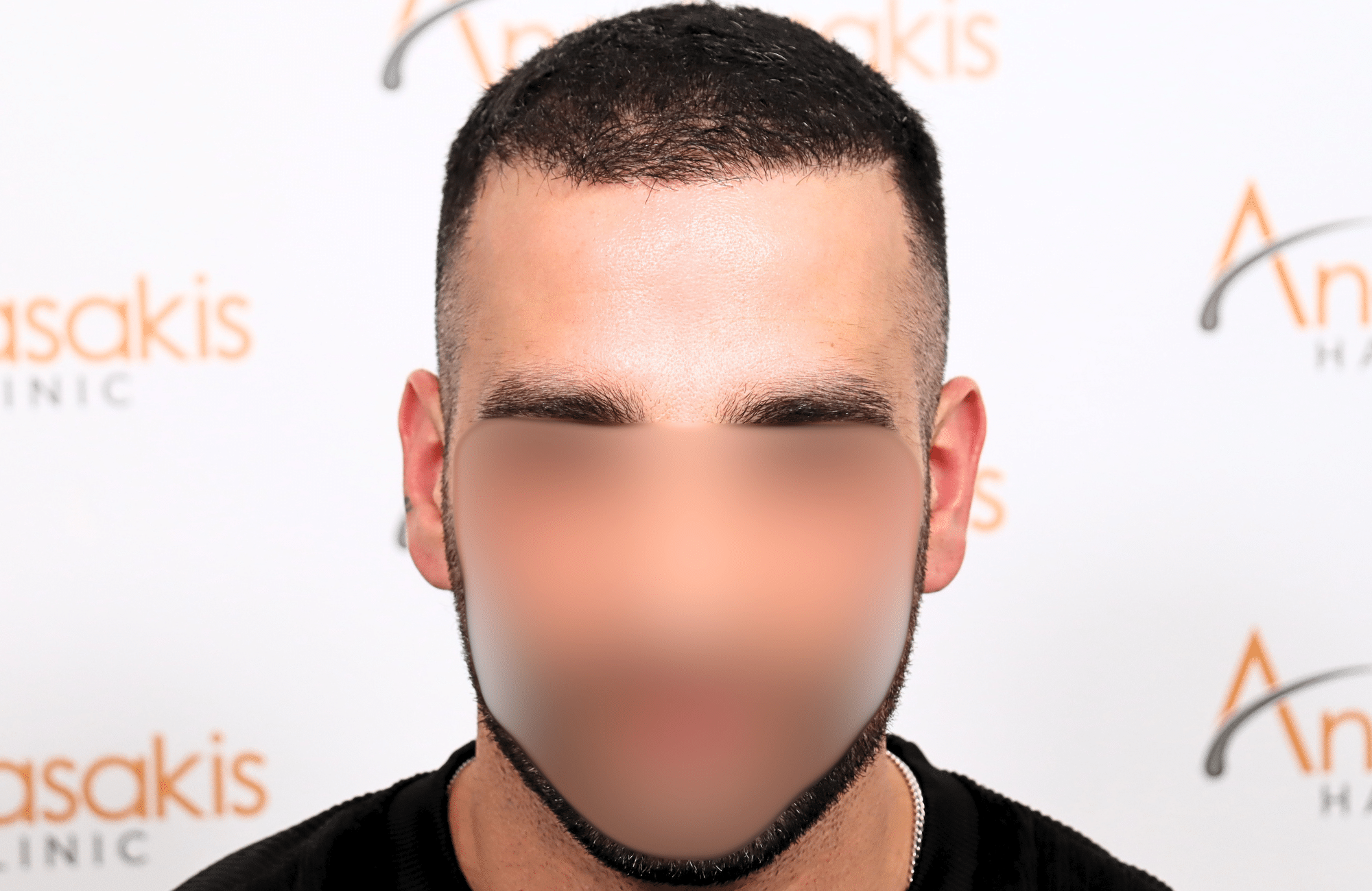 hair transplant result 2400 fus stage 3 short hair