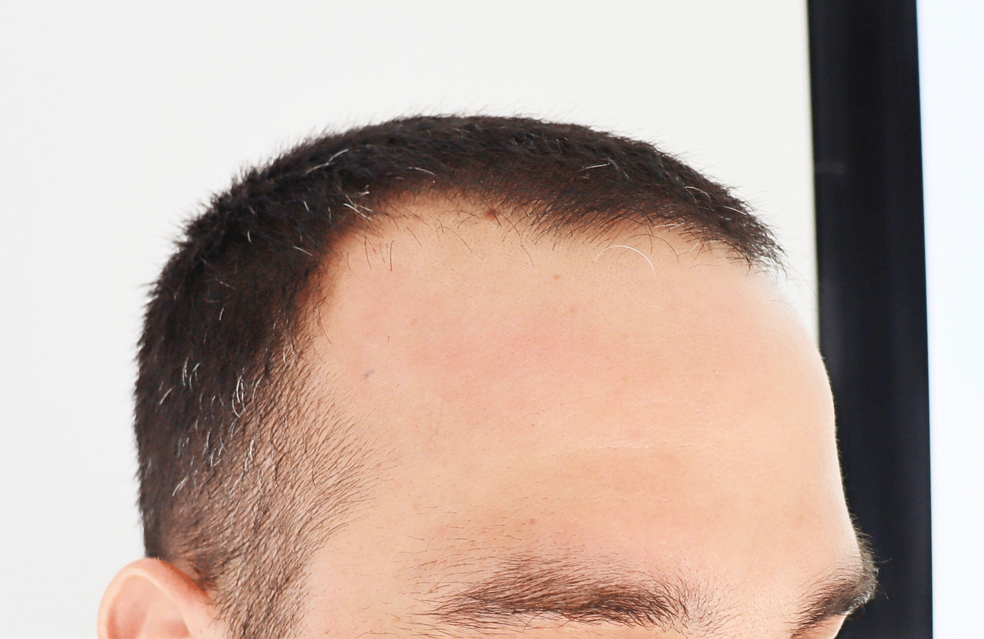 hair transplant result 2400 fus stage 3 short hair