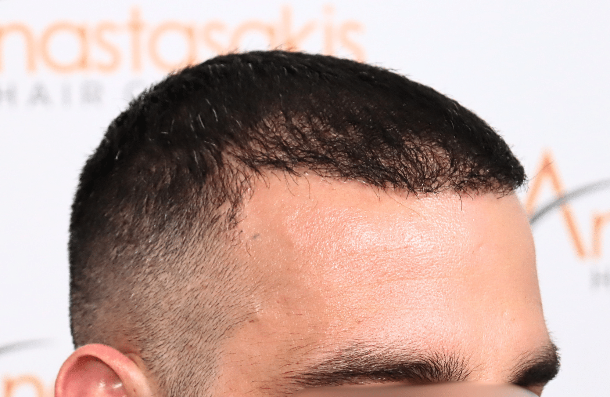 hair transplant result 2400 fus stage 3 short hair