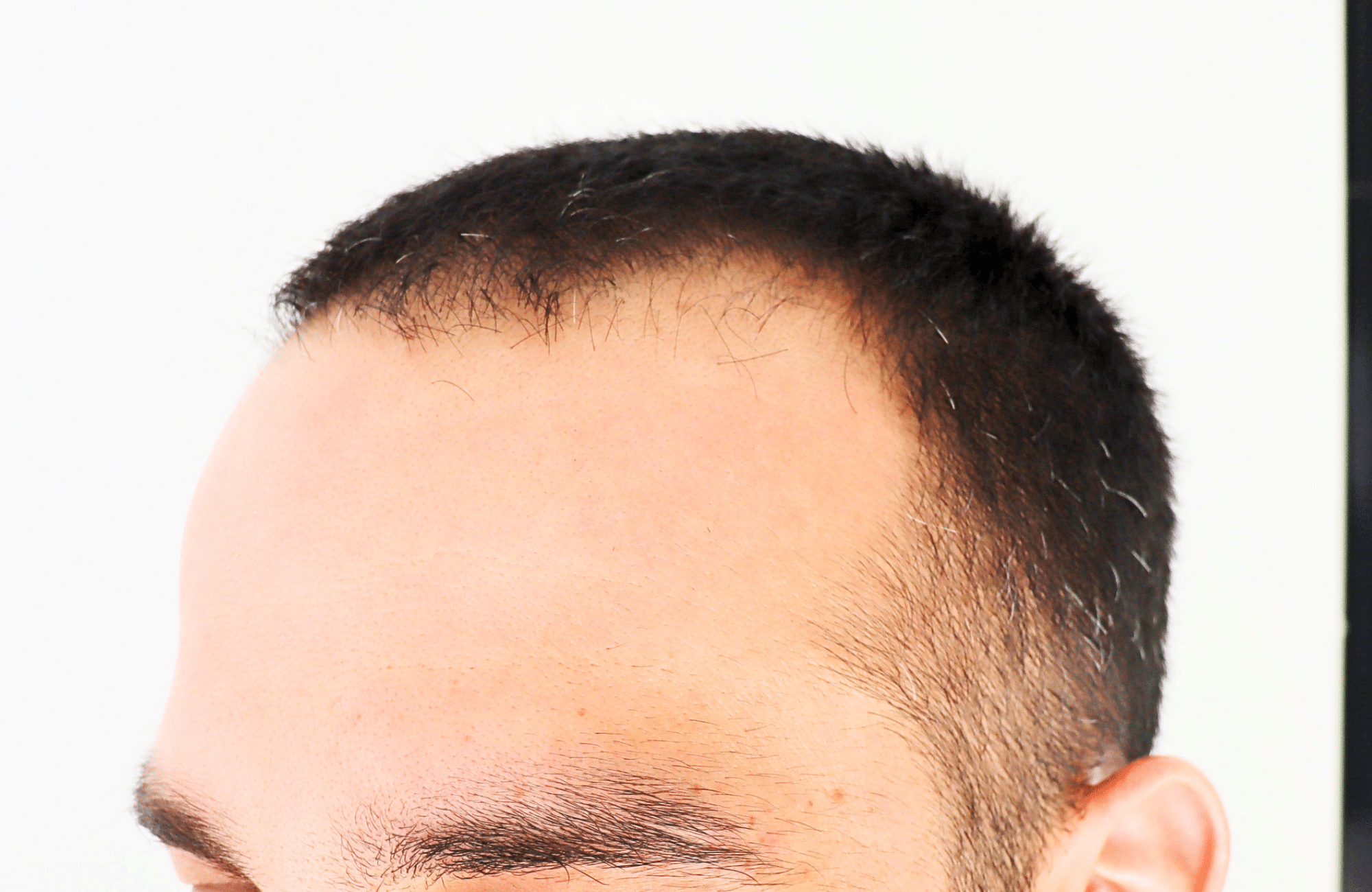 hair transplant result 2400 fus stage 3 short hair