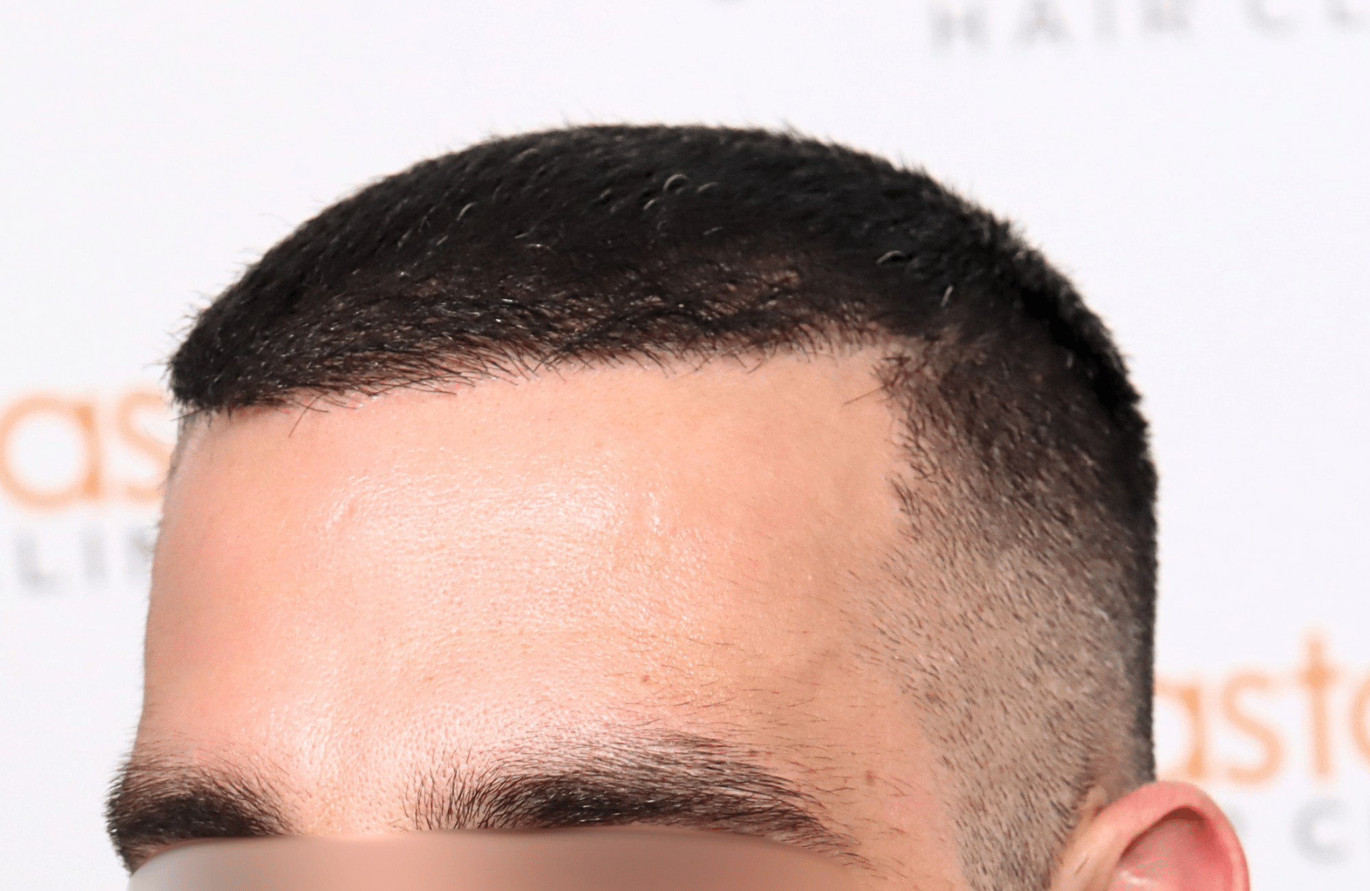 hair transplant result 2400 fus stage 3 short hair
