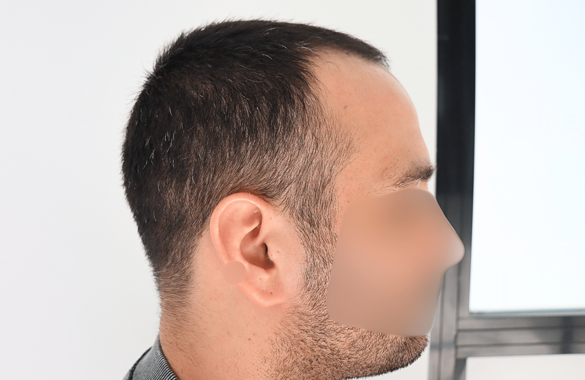 hair transplant result 2400 fus stage 3 short hair