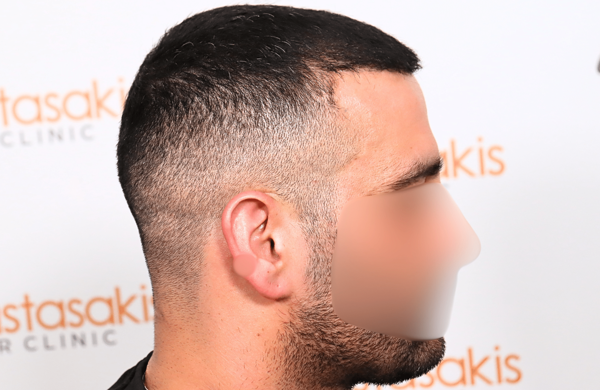 hair transplant result 2400 fus stage 3 short hair