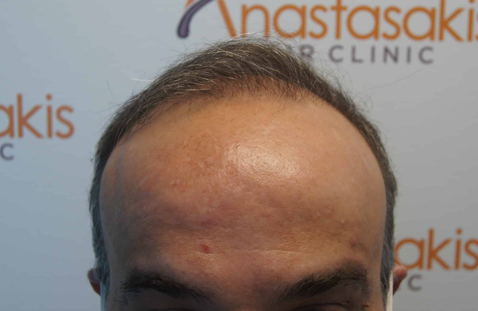 peristatiko metamosxefsis mallion me 3500 fus prin hairline