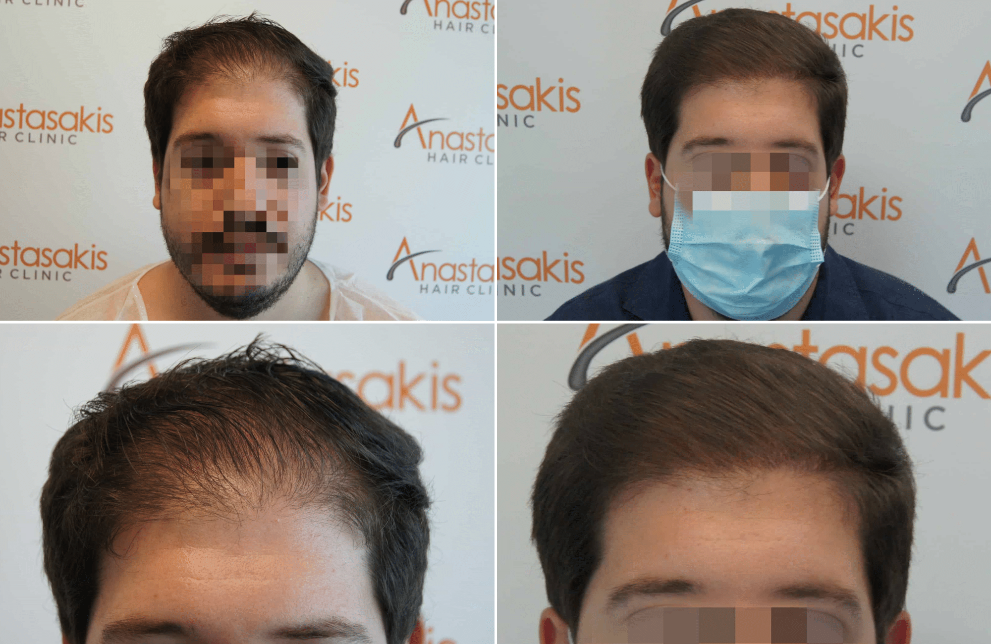 https://www.anastasakishairclinic.gr/portfolio/apotelesma-metamosxefsis-mallion-anastasakis-hair-clinic-346-2/