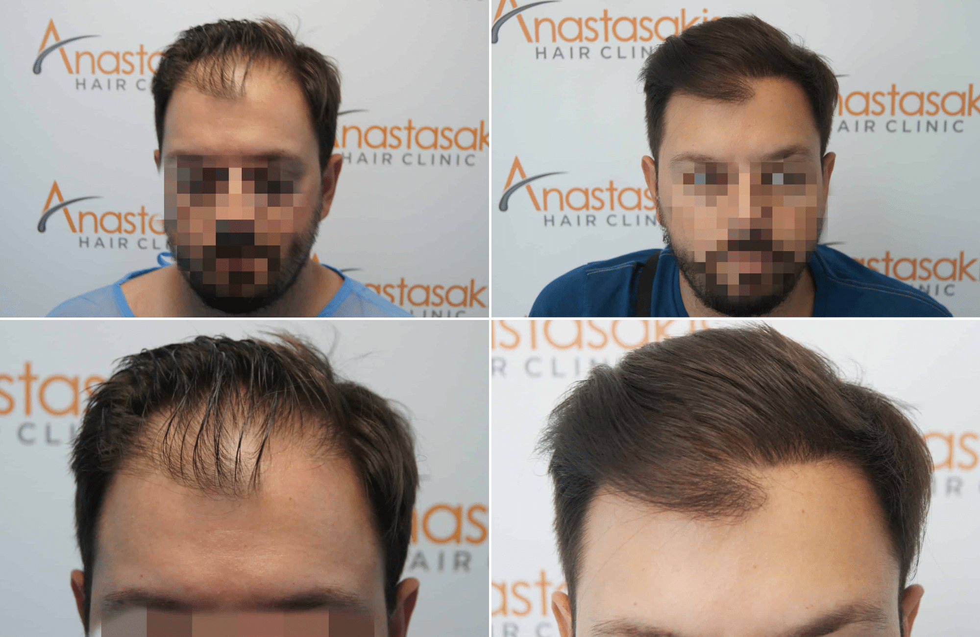 https://www.anastasakishairclinic.gr/portfolio/apotelesma-metamosxefsis-mallion-anastasakis-hair-clinic-348/