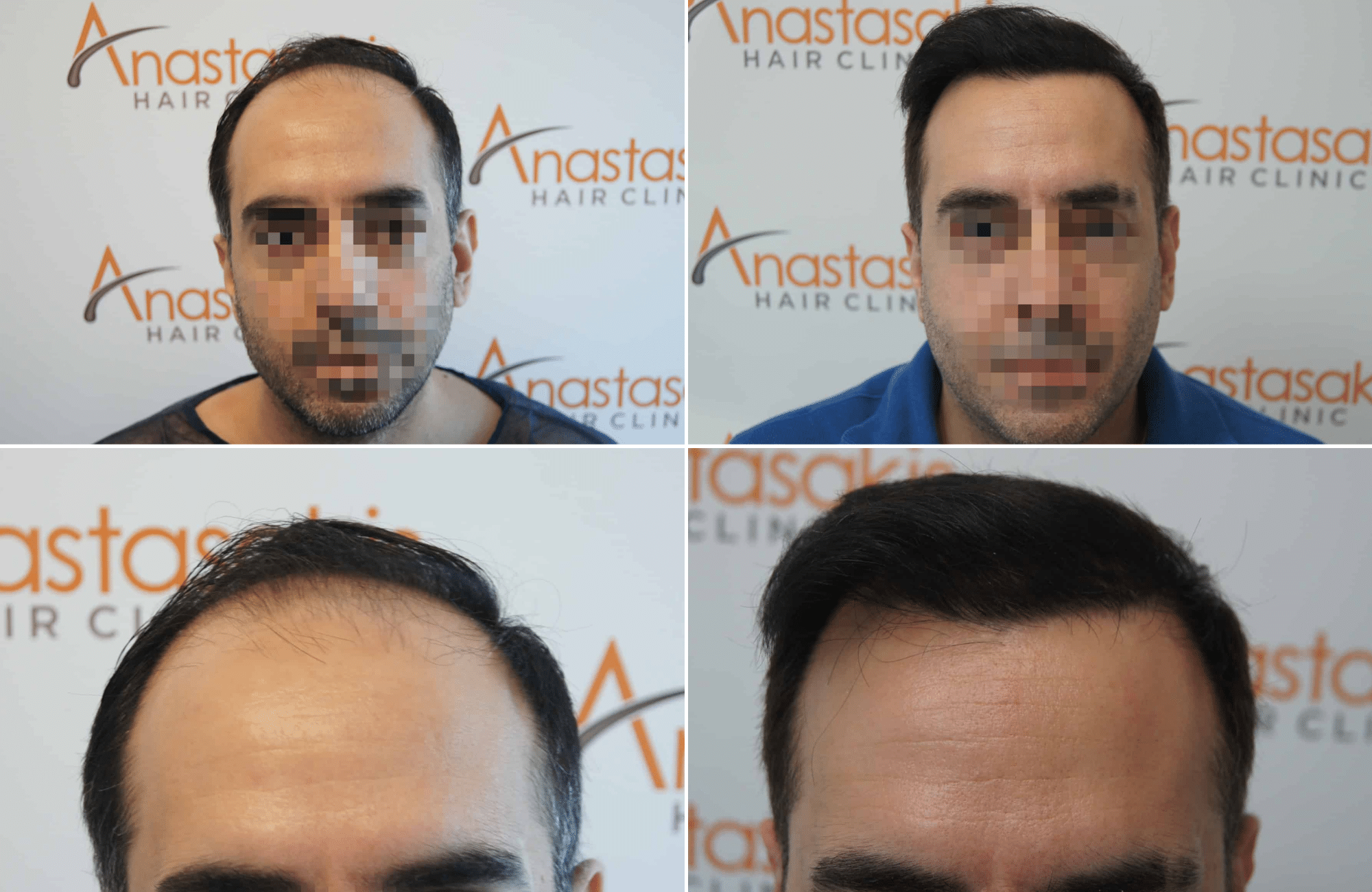 https://www.anastasakishairclinic.gr/portfolio/apotelesma-metamosxefsis-mallion-anastasakis-hair-clinic-349/