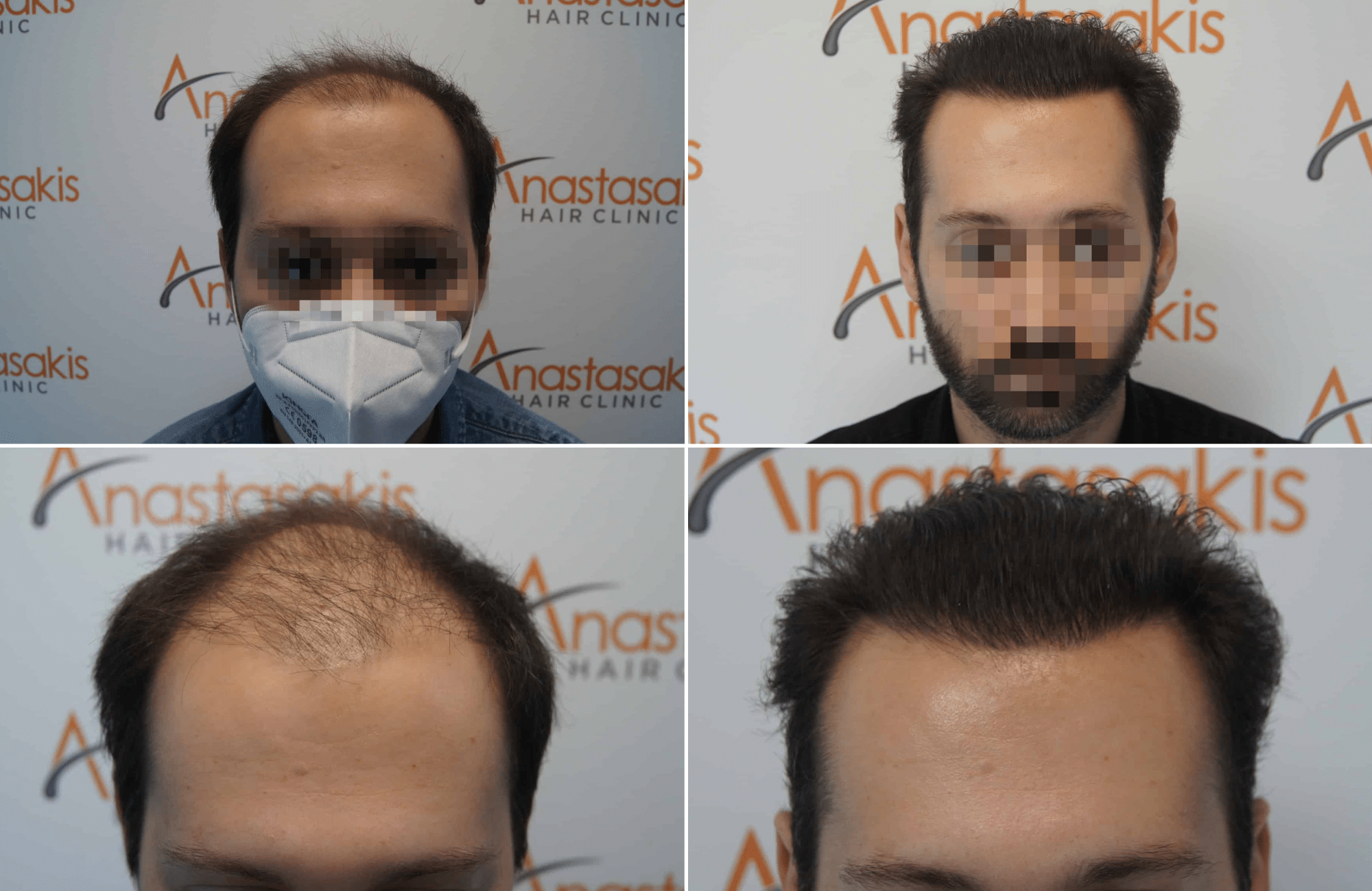 https://www.anastasakishairclinic.gr/portfolio/apotelesma-metamosxefsis-mallion-anastasakis-hair-clinic-350/
