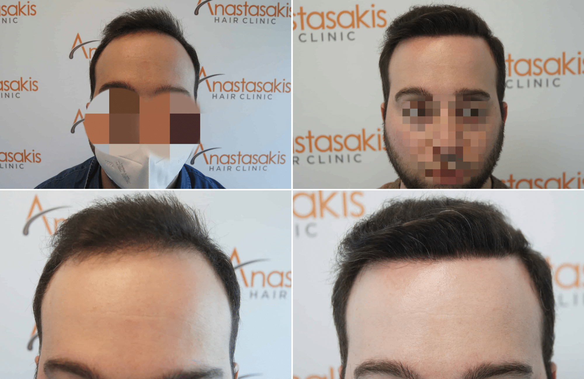 https://www.anastasakishairclinic.gr/portfolio/apotelesma-metamosxefsis-mallion-anastasakis-hair-clinic-351/