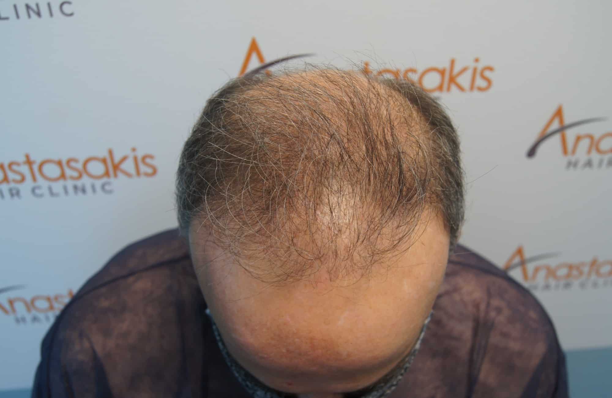 peristatiko metamosxefsis mallion me 3500 fus prin up