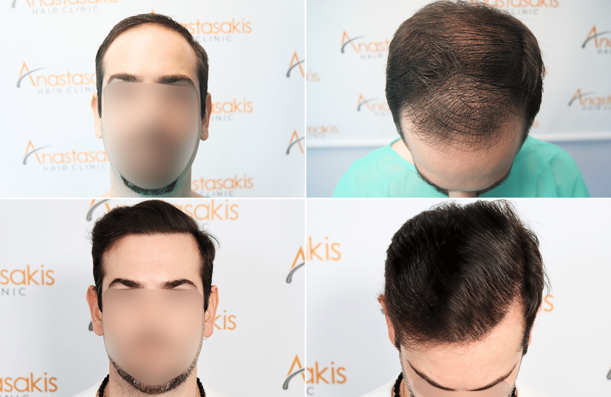 https://www.anastasakishairclinic.gr/portfolio/apotelesma-metamosxefsis-mallion-anastasakis-hair-clinic-97/