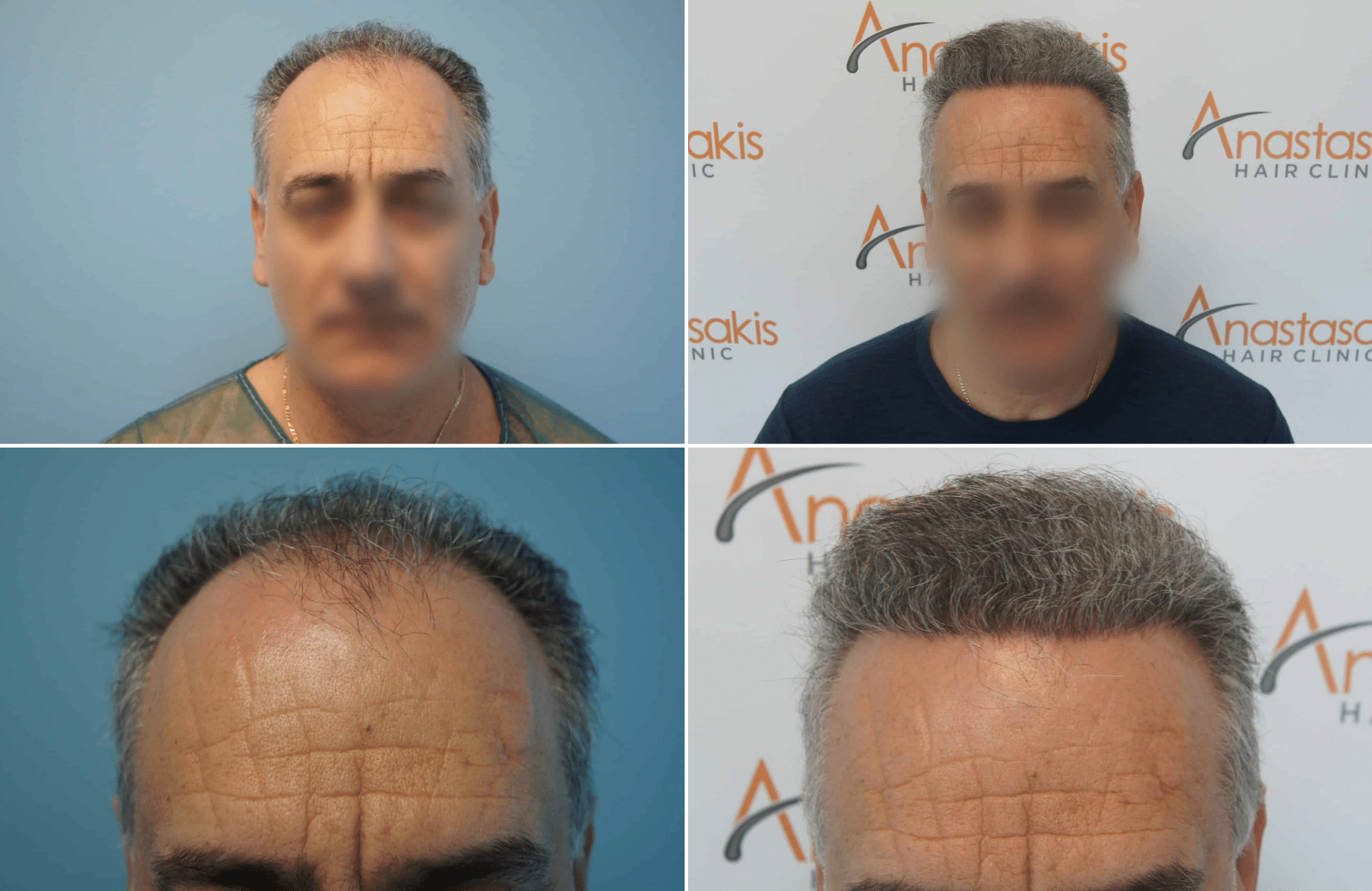 https://www.anastasakishairclinic.gr/portfolio/apotelesma-metamosxefsis-mallion-anastasakis-hair-clinic-352/